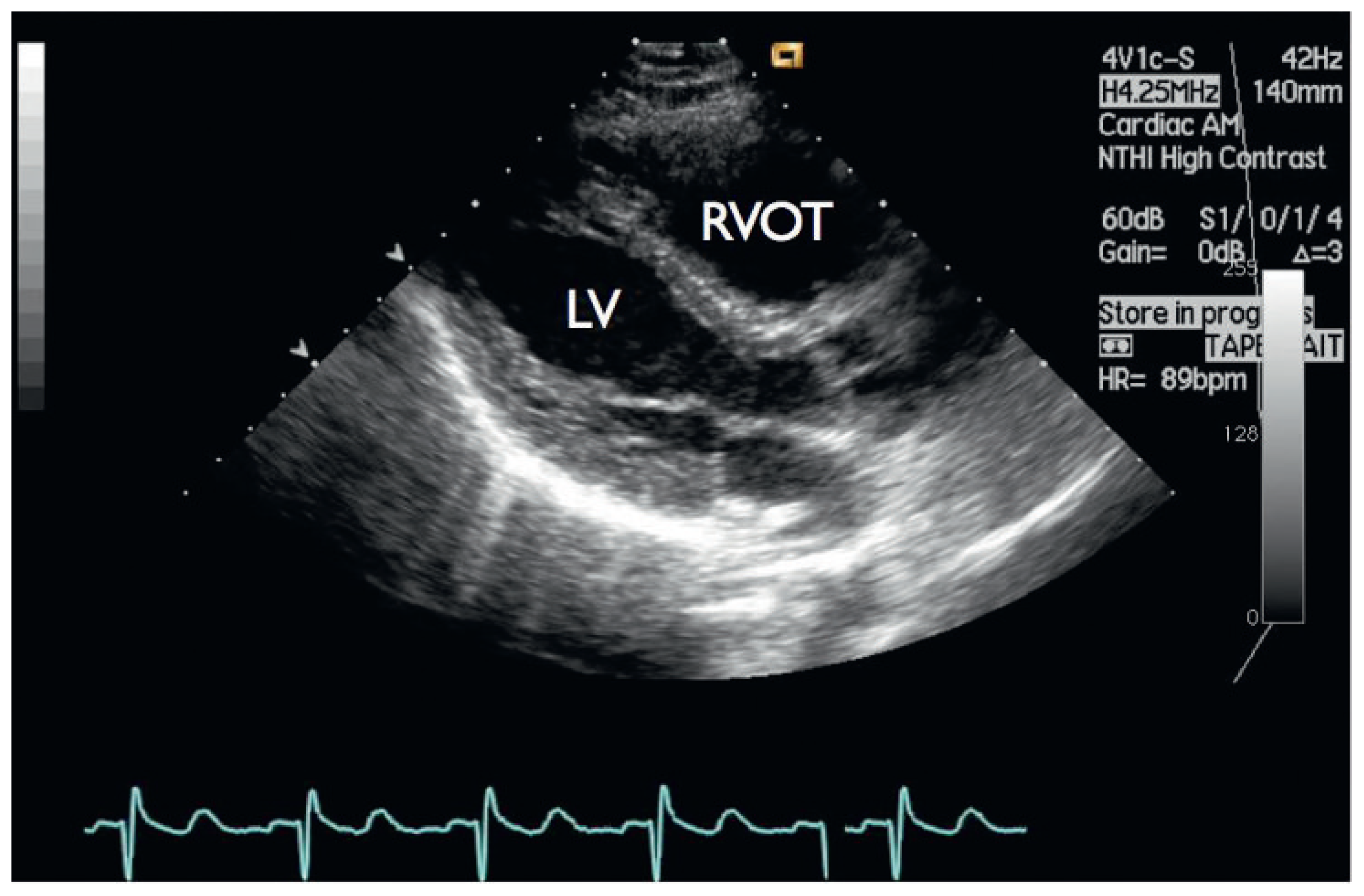Cardiovascmed 14 00098 g005 Cardiovascmed 14 00098 g005
