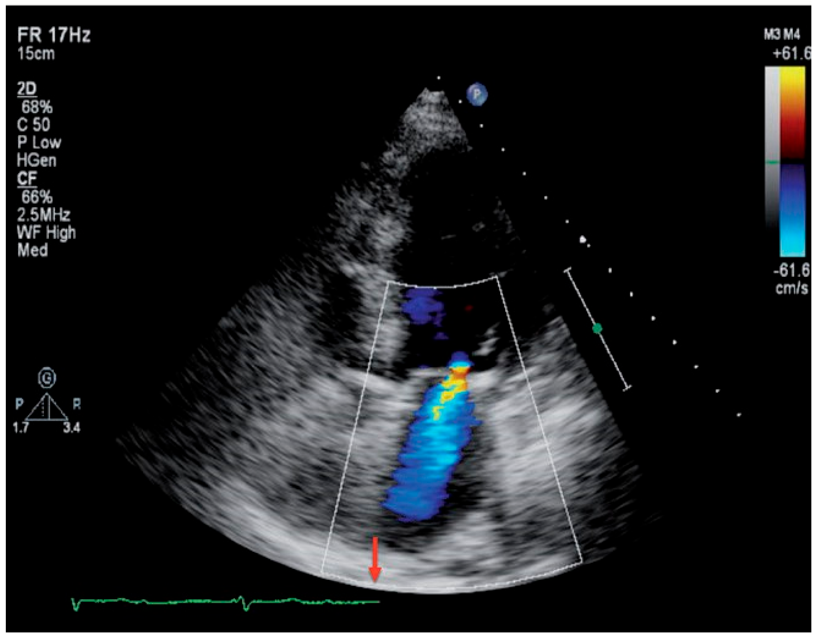 Cardiovascmed 14 00163 g001 Cardiovascmed 14 00163 g001