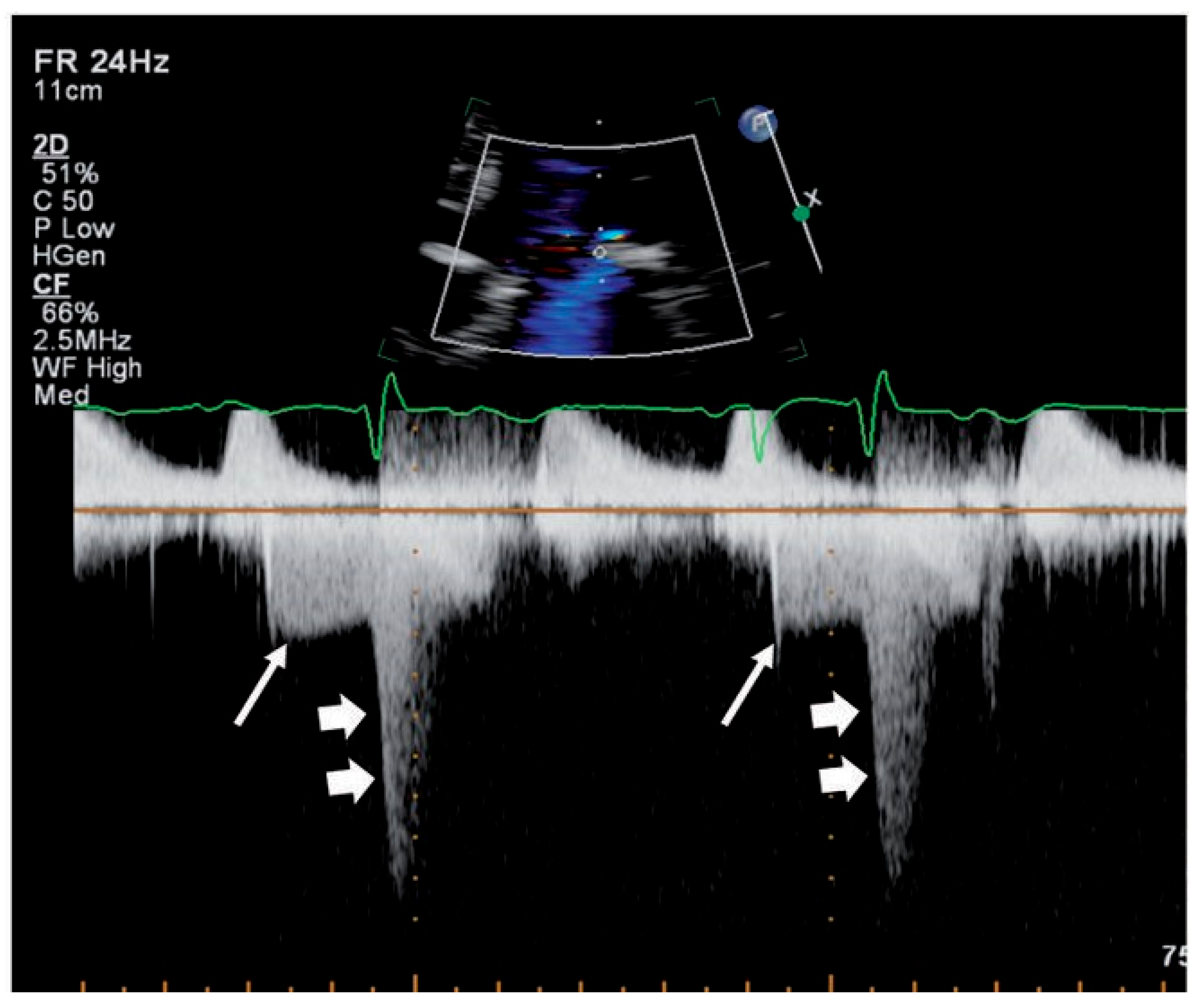 Cardiovascmed 14 00163 g002 Cardiovascmed 14 00163 g002