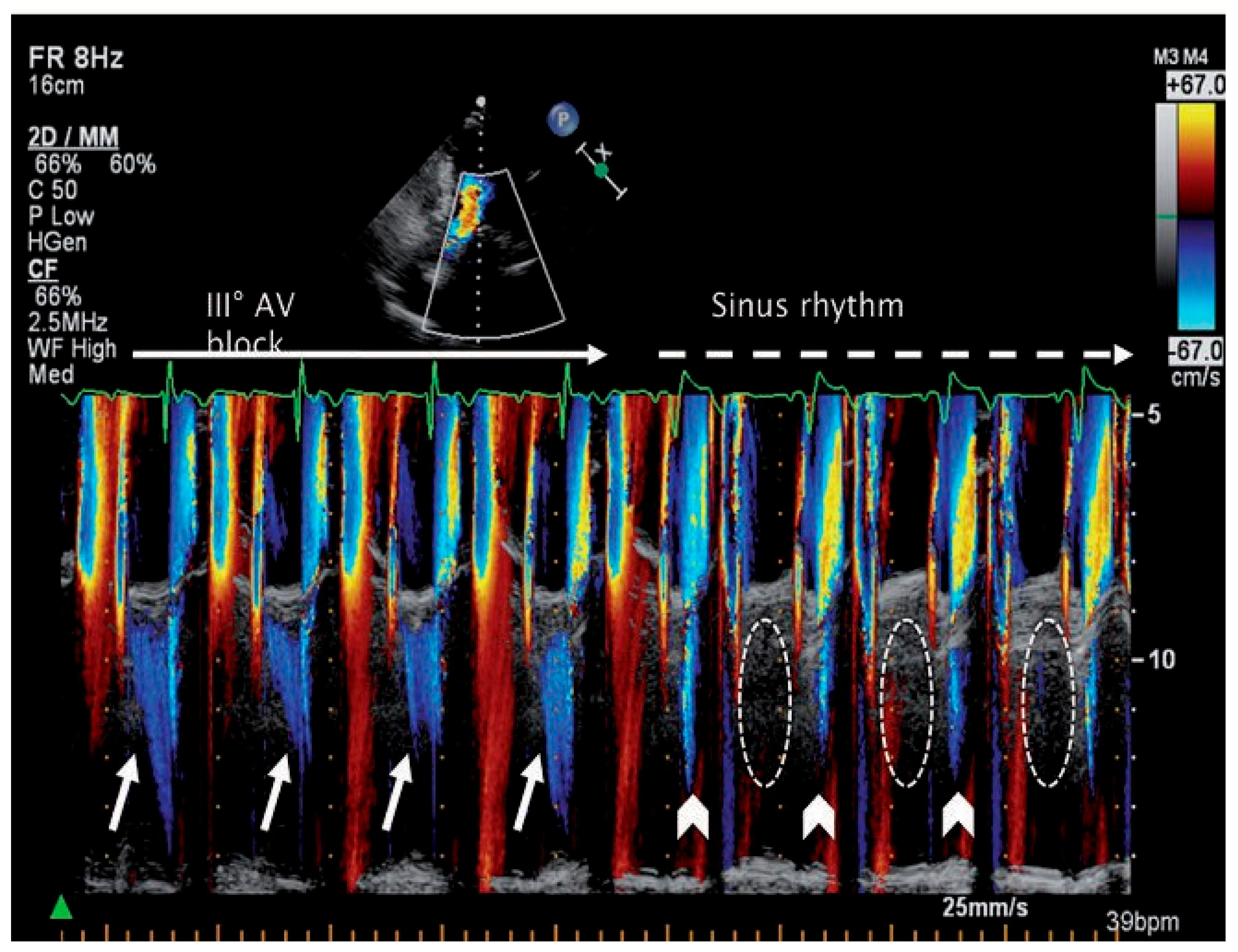 Cardiovascmed 14 00163 g003 Cardiovascmed 14 00163 g003