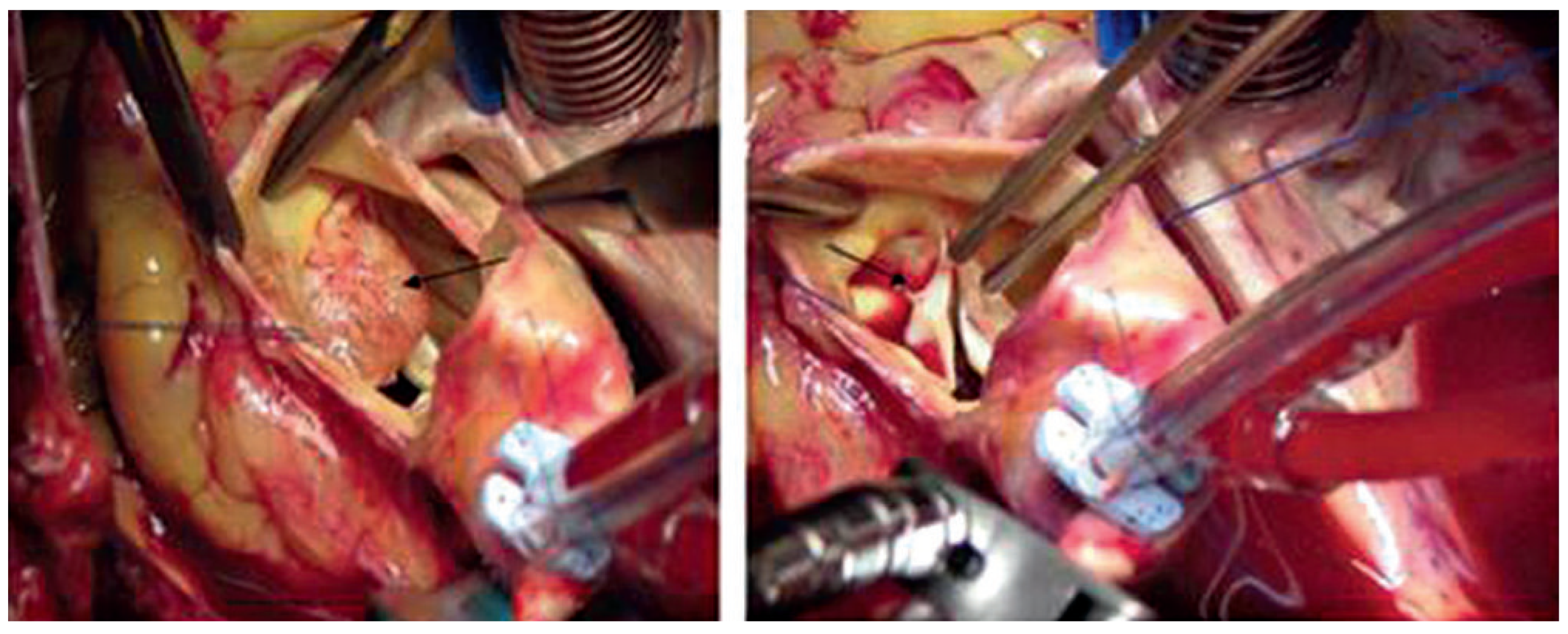 Cardiovascmed 14 00242 g005 Cardiovascmed 14 00242 g005