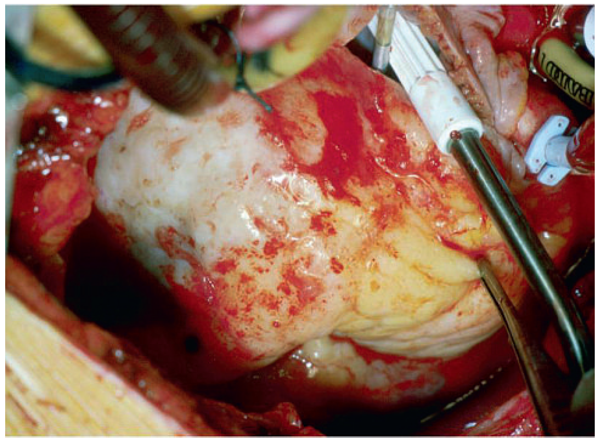 Cardiovascmed 14 00242 g011 Cardiovascmed 14 00242 g011