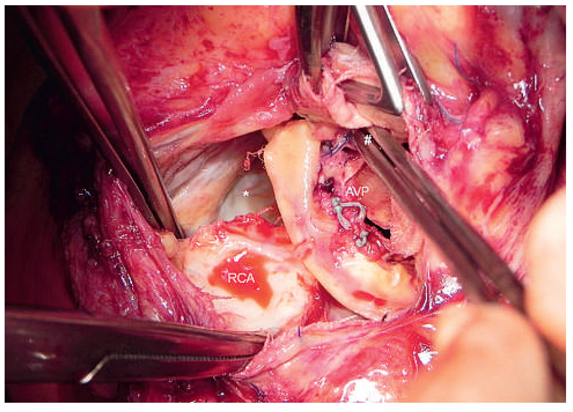 Cardiovascmed 17 00095 g005 Cardiovascmed 17 00095 g005