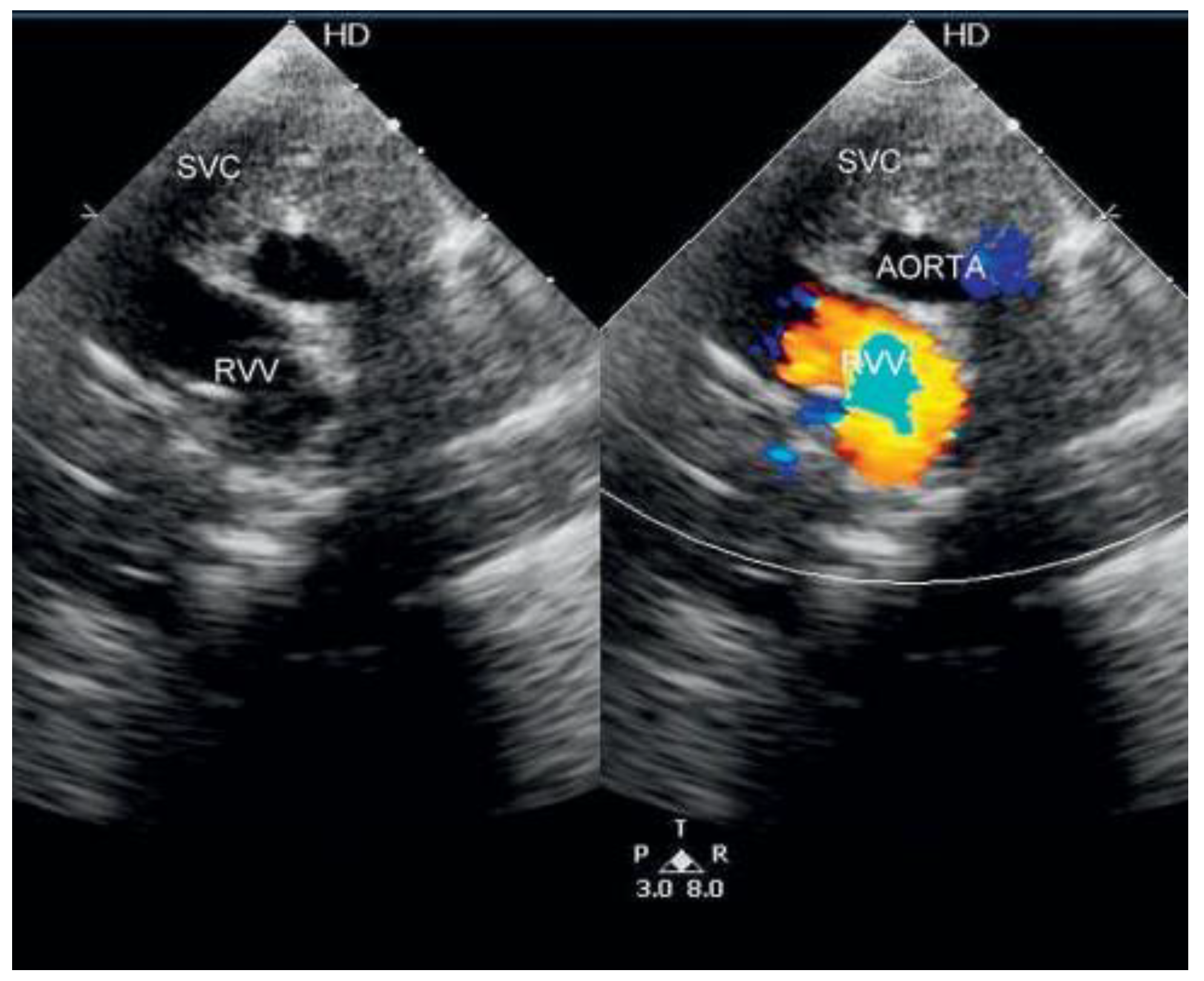 Cardiovascmed 17 00273 g004 Cardiovascmed 17 00273 g004