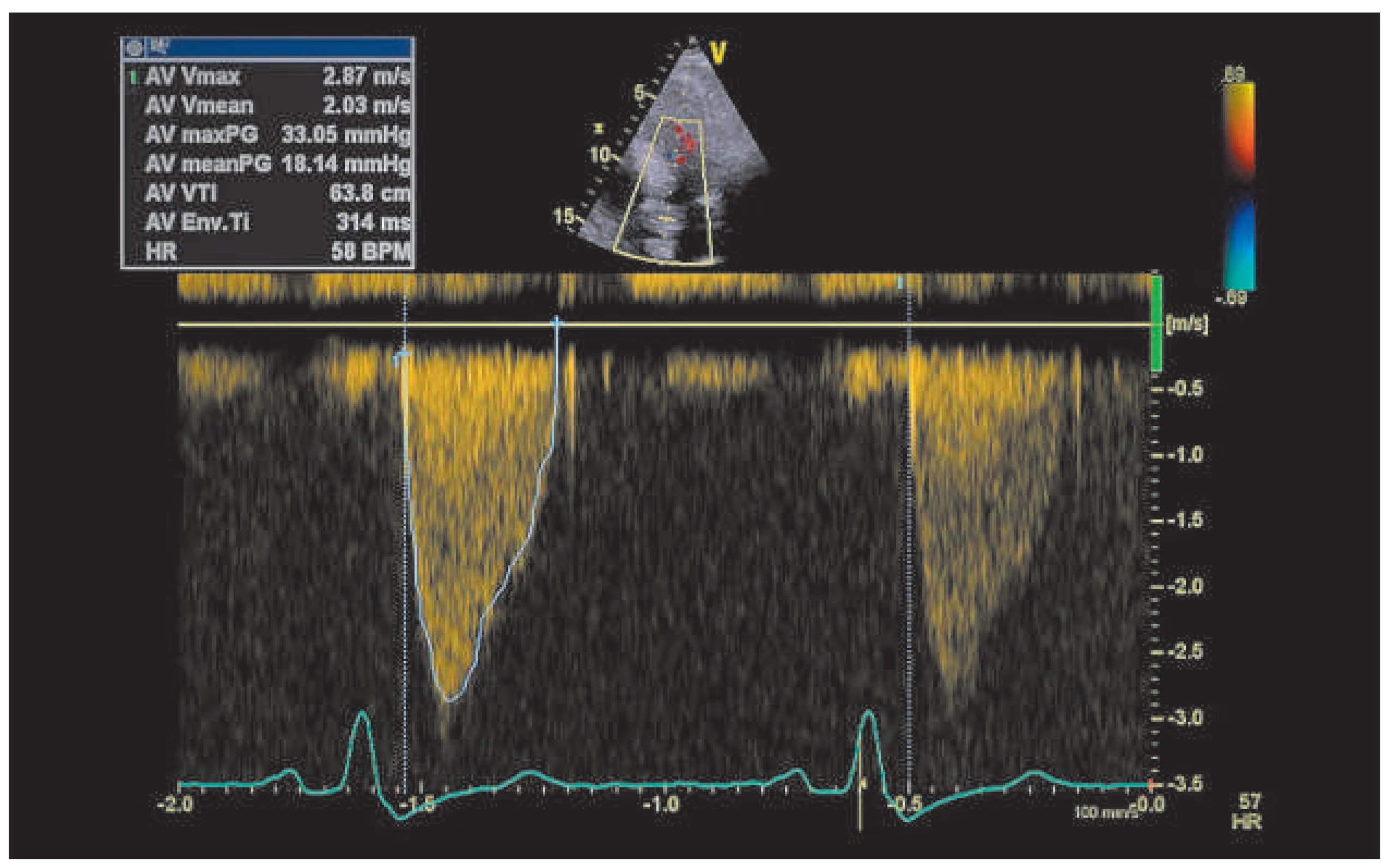 Cardiovascmed 18 00222 g004 Cardiovascmed 18 00222 g004
