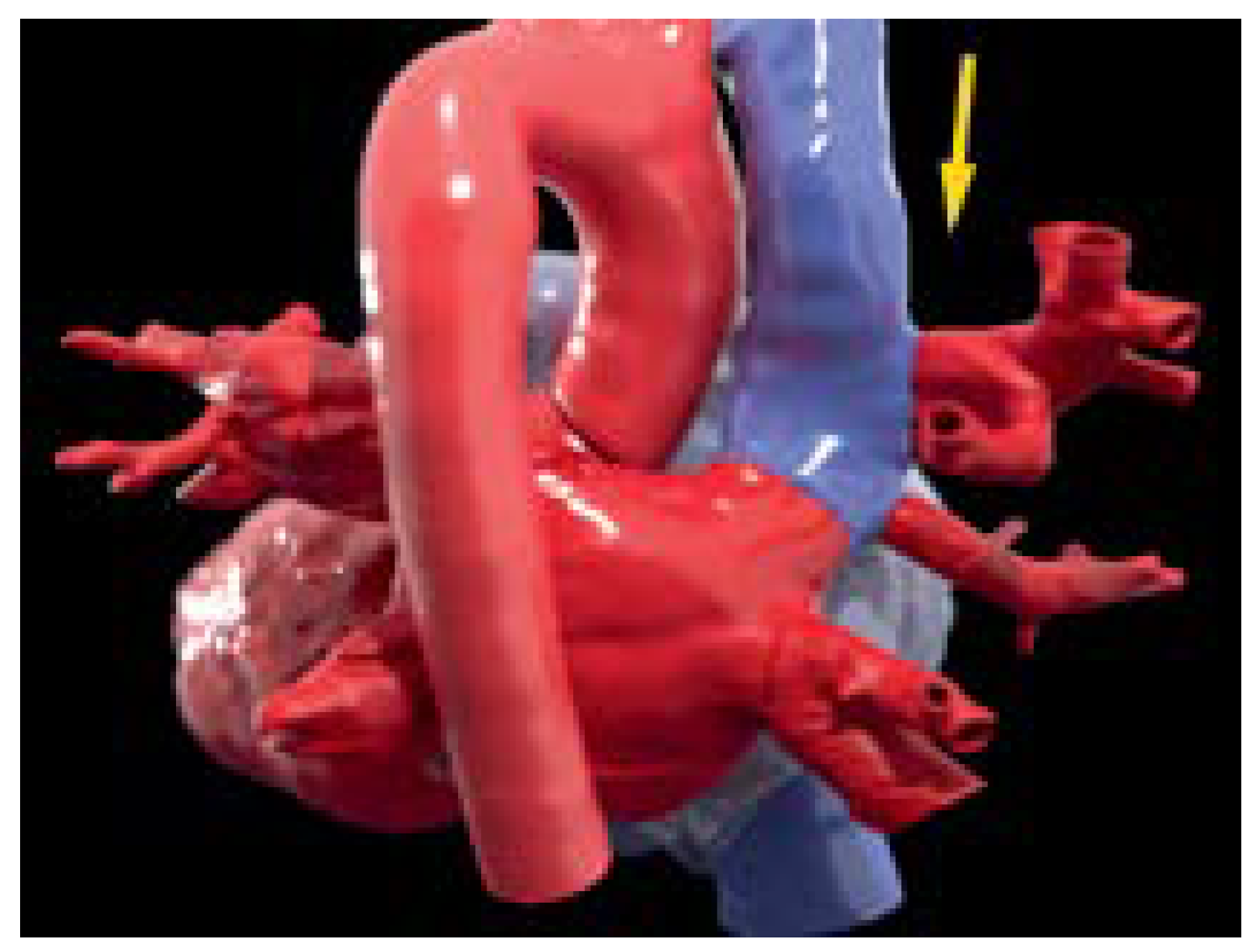 Cardiovascmed 25 00124 g005 Cardiovascmed 25 00124 g005