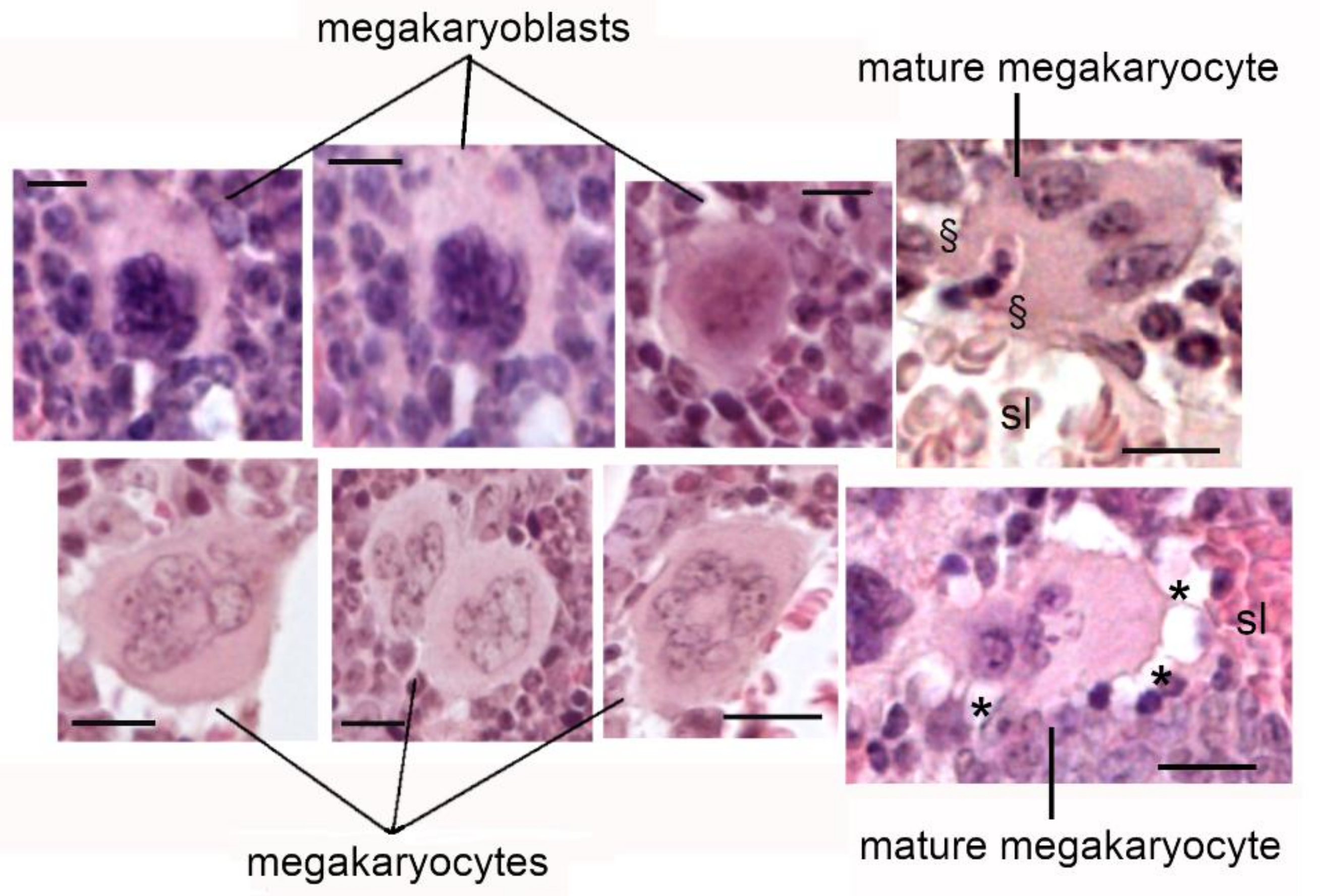 Cellular Therapy and Stem Cells for Blood Disorders
These large bone marrow cells give rise to platelets through a process called thrombopoiesis. Dysfunction in megakaryocyte activity contributes to thrombocytopenia, a hallmark of various blood disorders.
