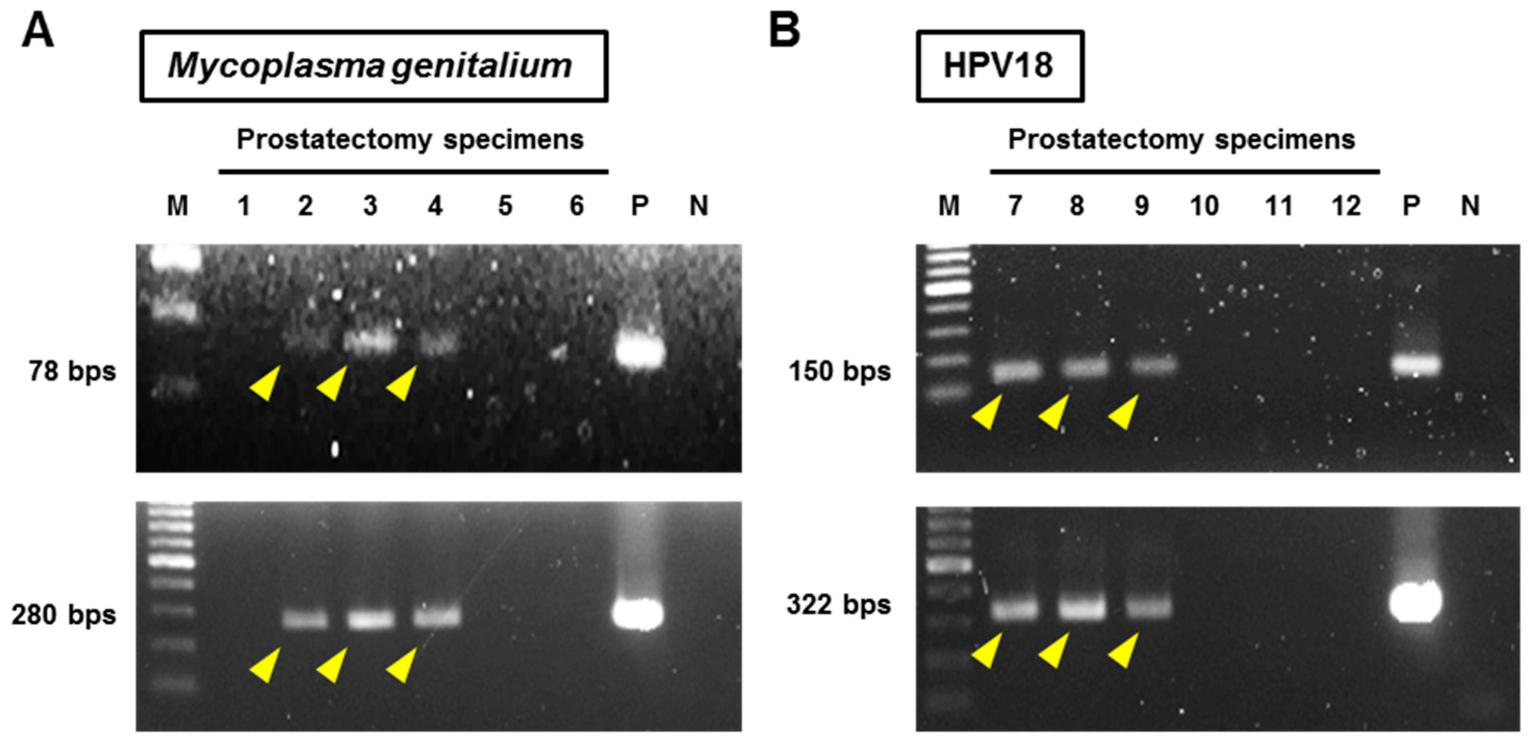 Mycoplasma prosztatitis ICD 10 Crona Prosztatitis