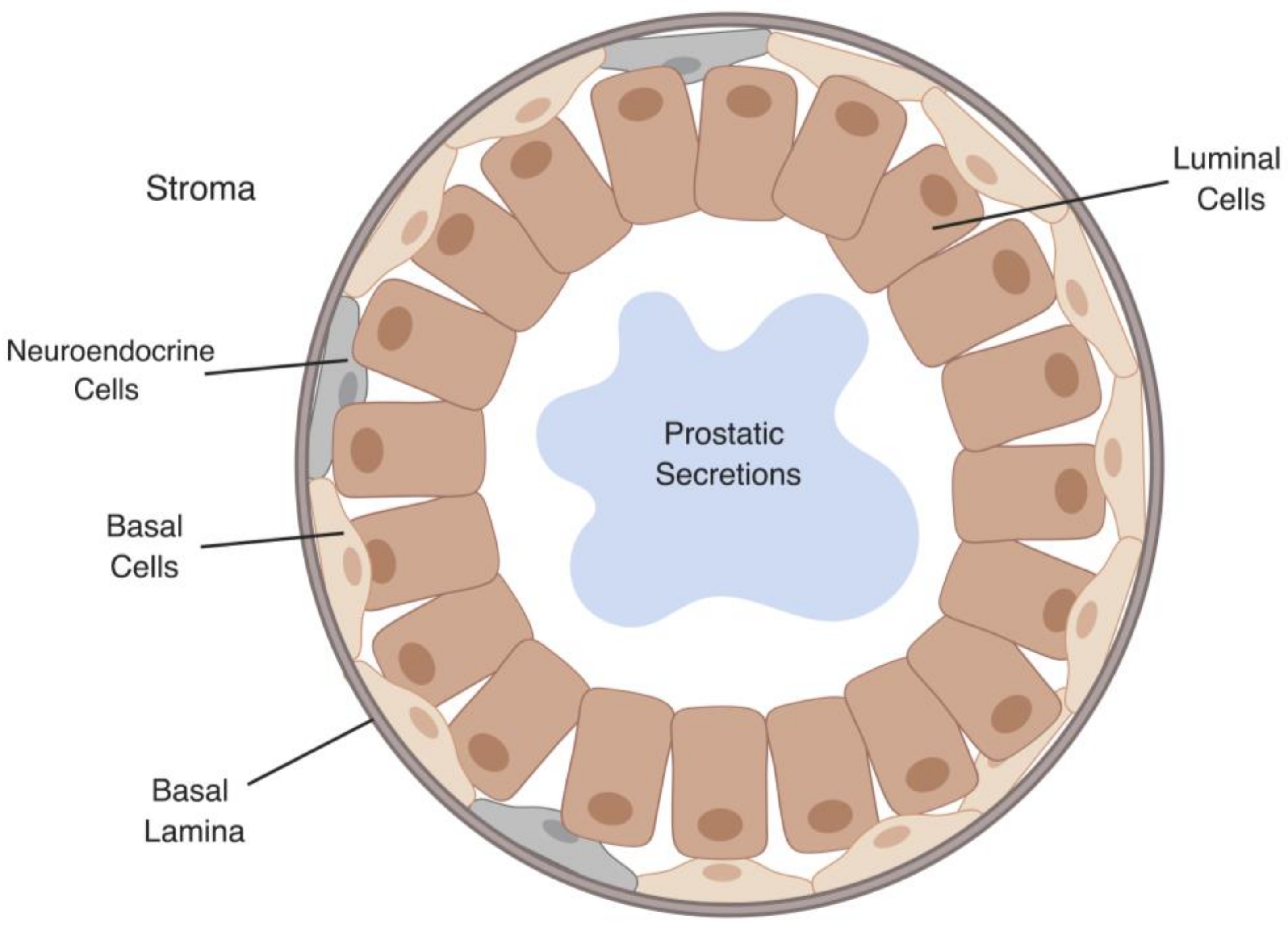 prostate cancer cell types)