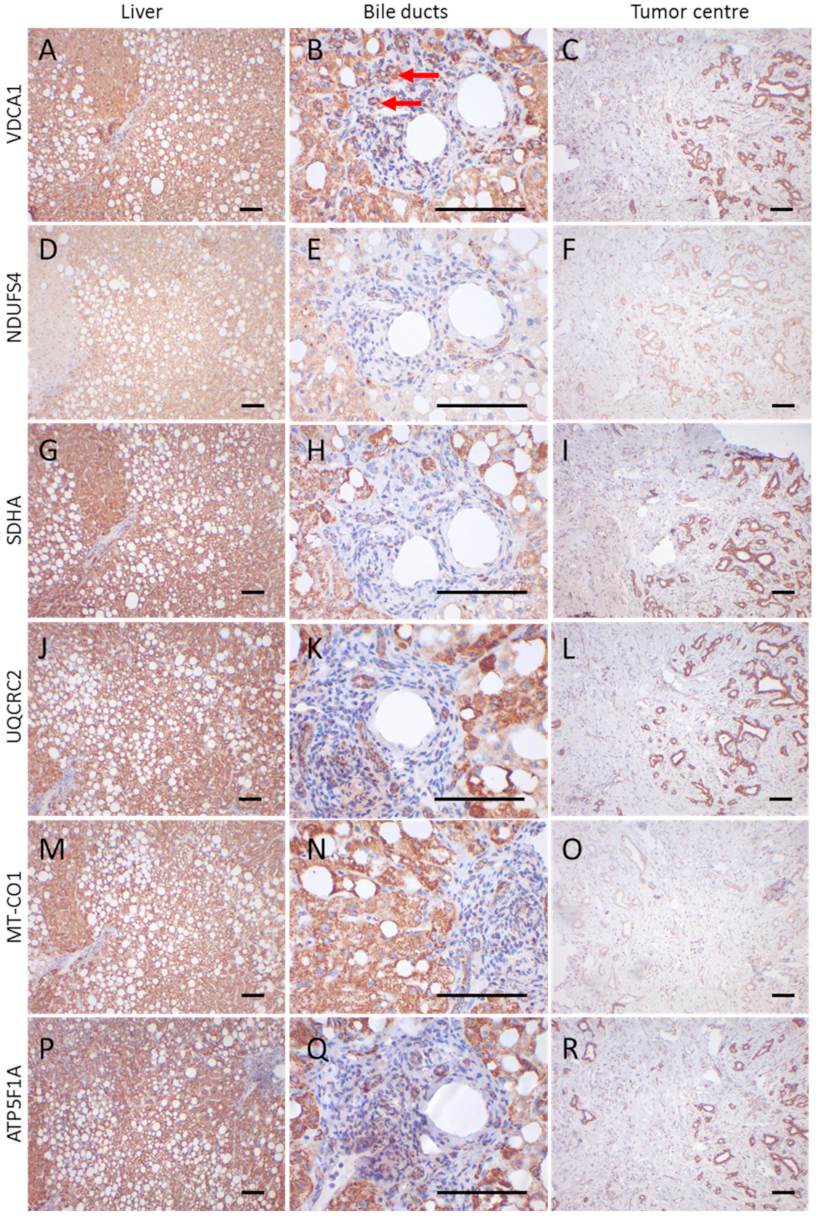 Cells Free Full Text Low Vdac1 Expression Is Associated With An Aggressive Phenotype And Reduced Overall Patient Survival In Cholangiocellular Carcinoma Html