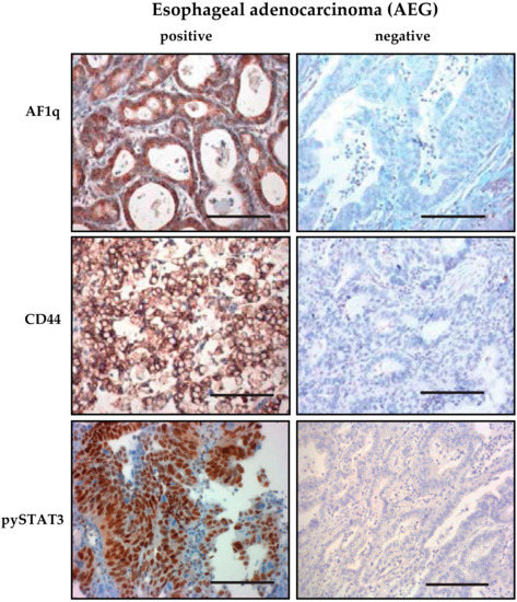 The Oncogene AF1Q is Associated with WNT and STAT Signaling and Offers ...