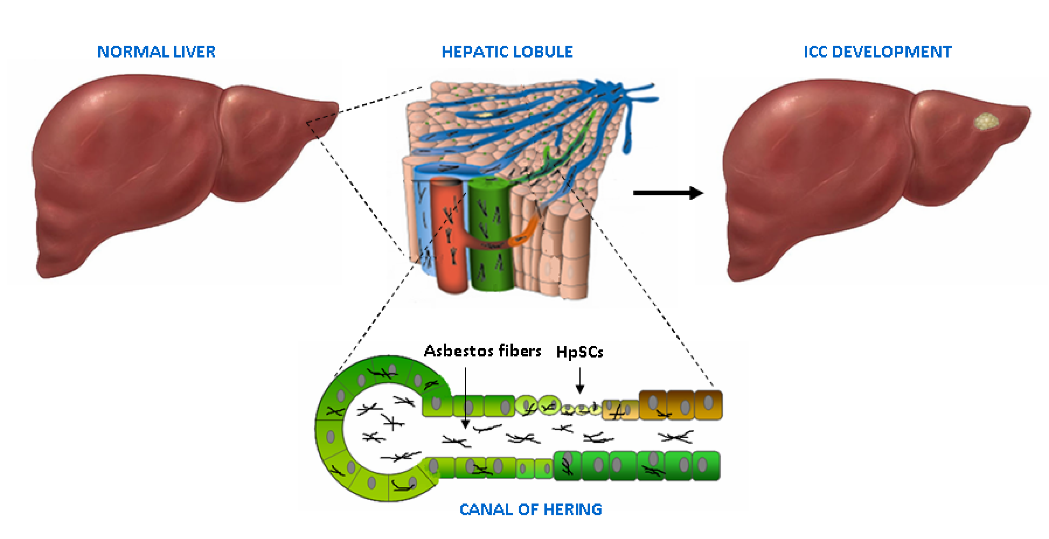 carcinoma ex pleomorphic adenoma symptoms