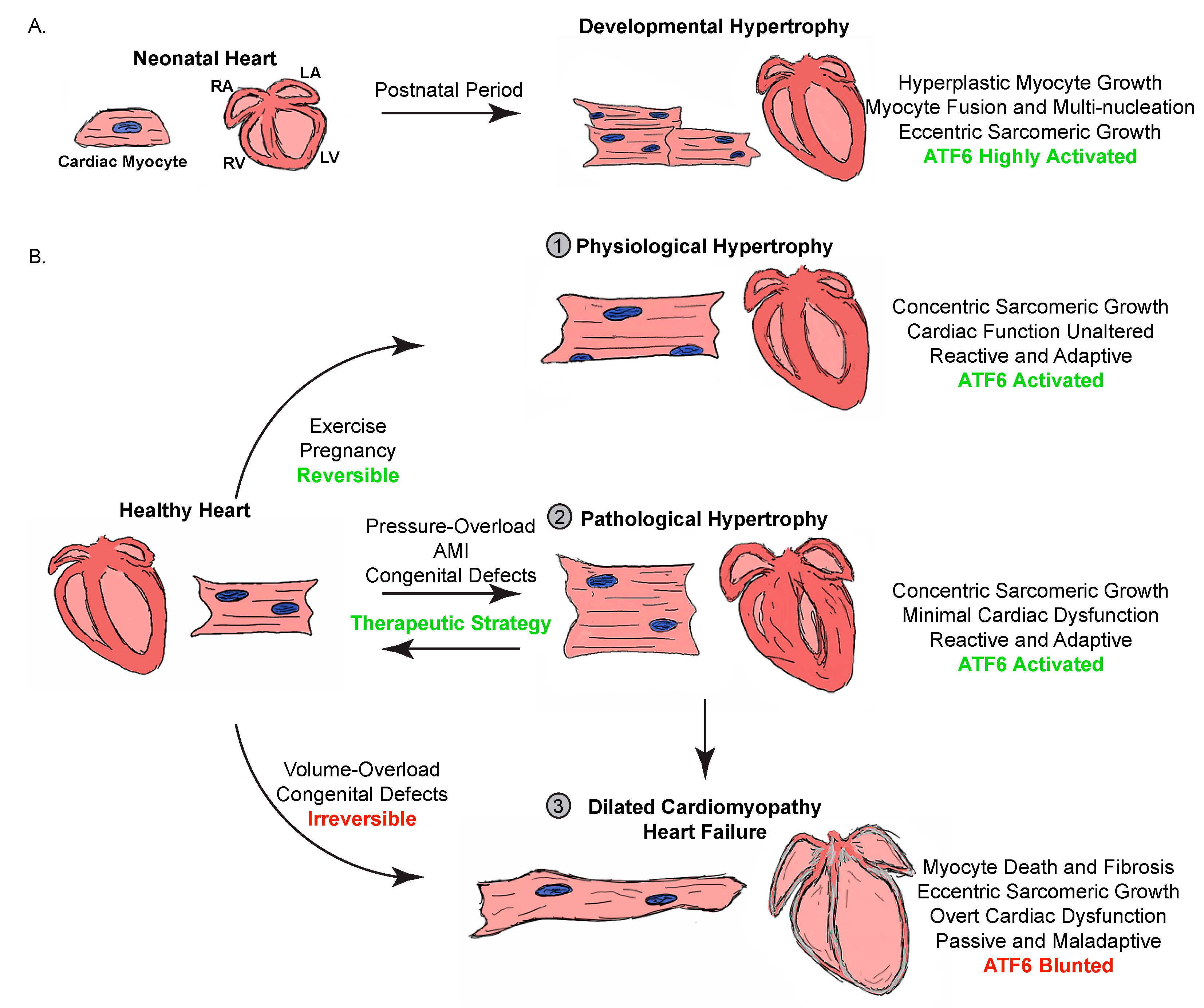 pathological hypertrophy heart diagram pathological hypertrophy heart diagram