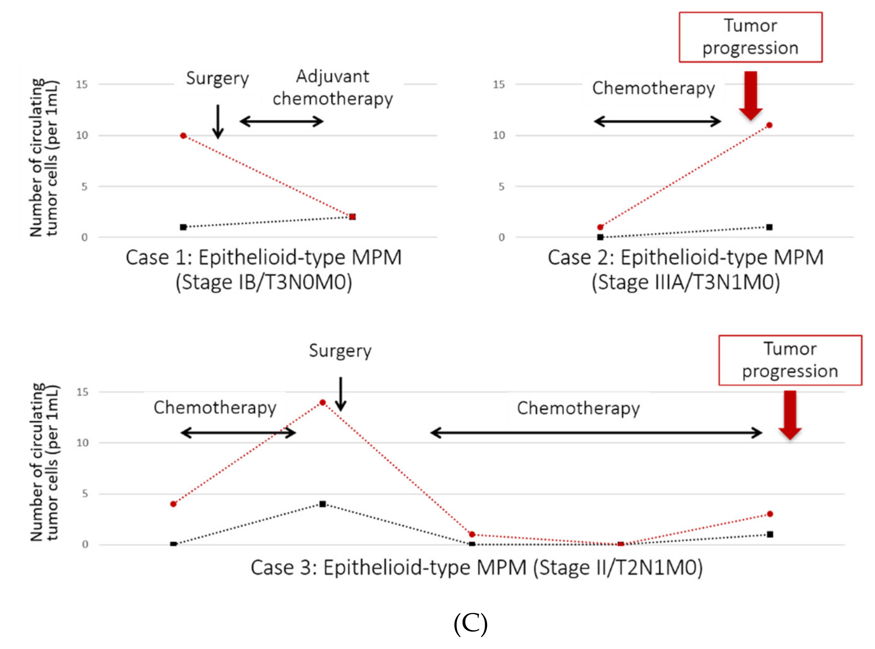 mesothelioma lung mass