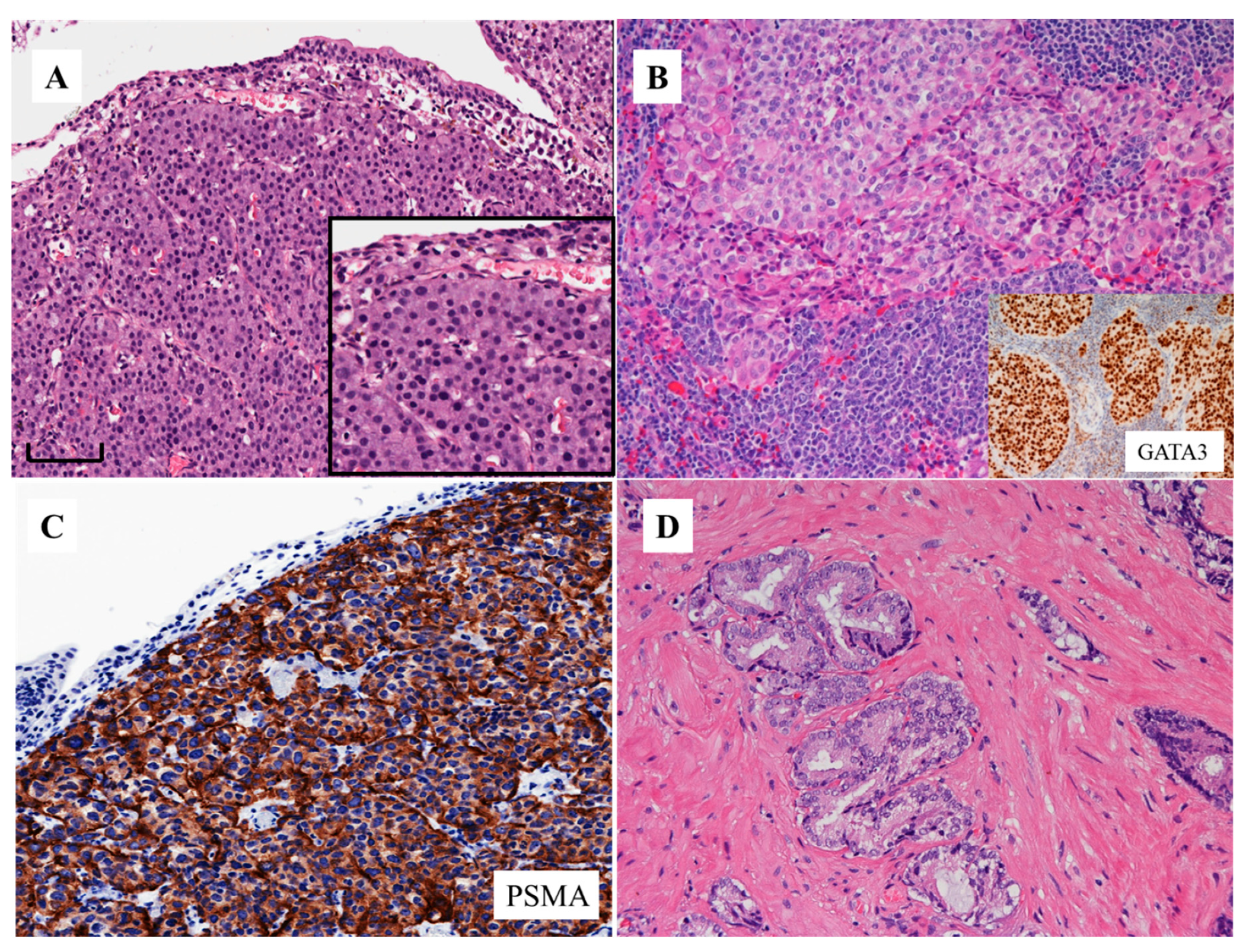 prostate cancer histology types