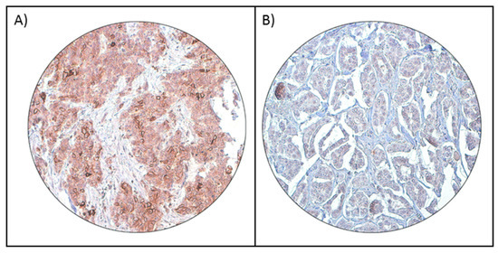 PD-L1 Protein Expression in Middle Eastern Breast Cancer Predicts ...