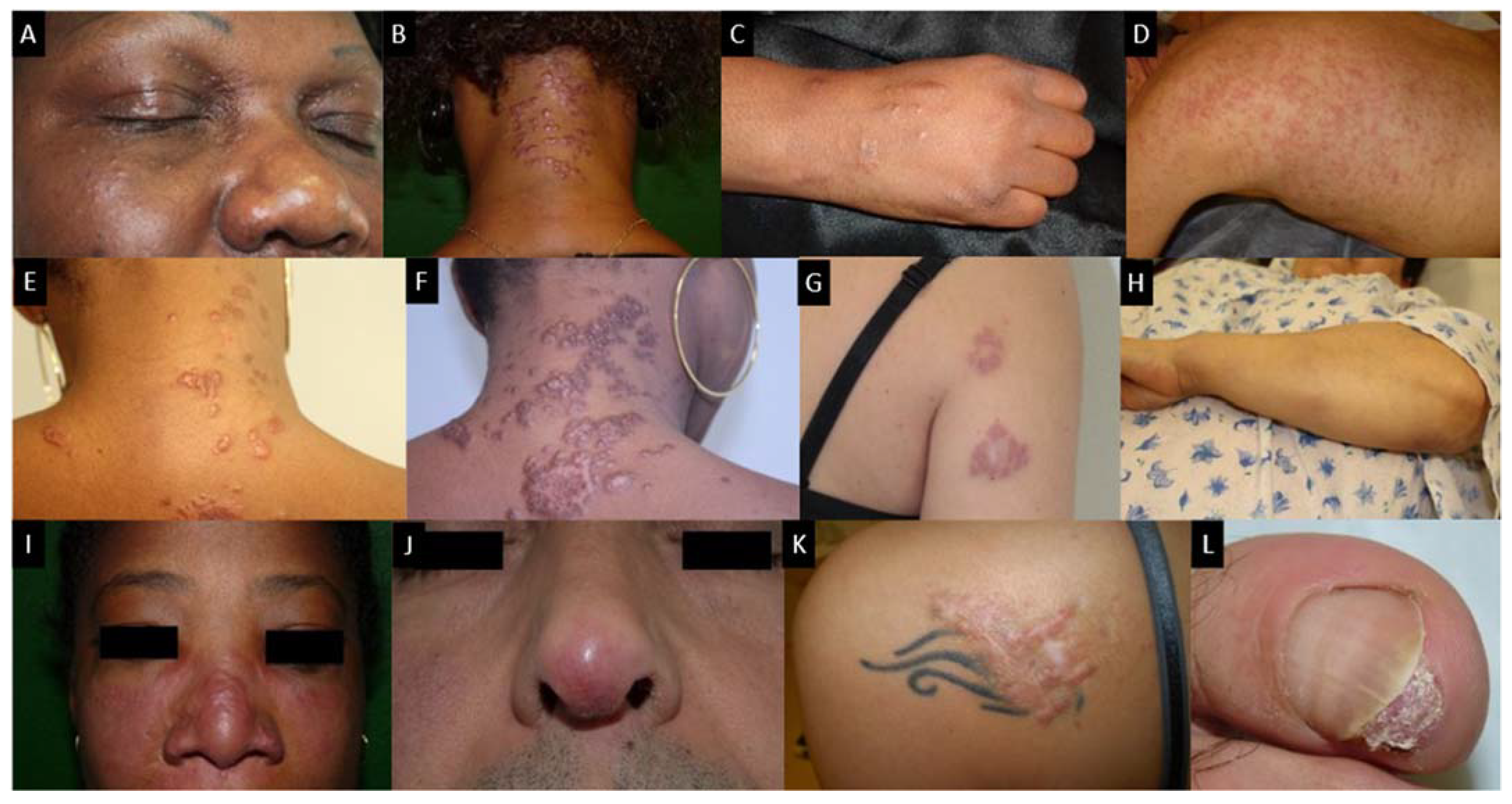 sarcoidosis life expectancy in the lung