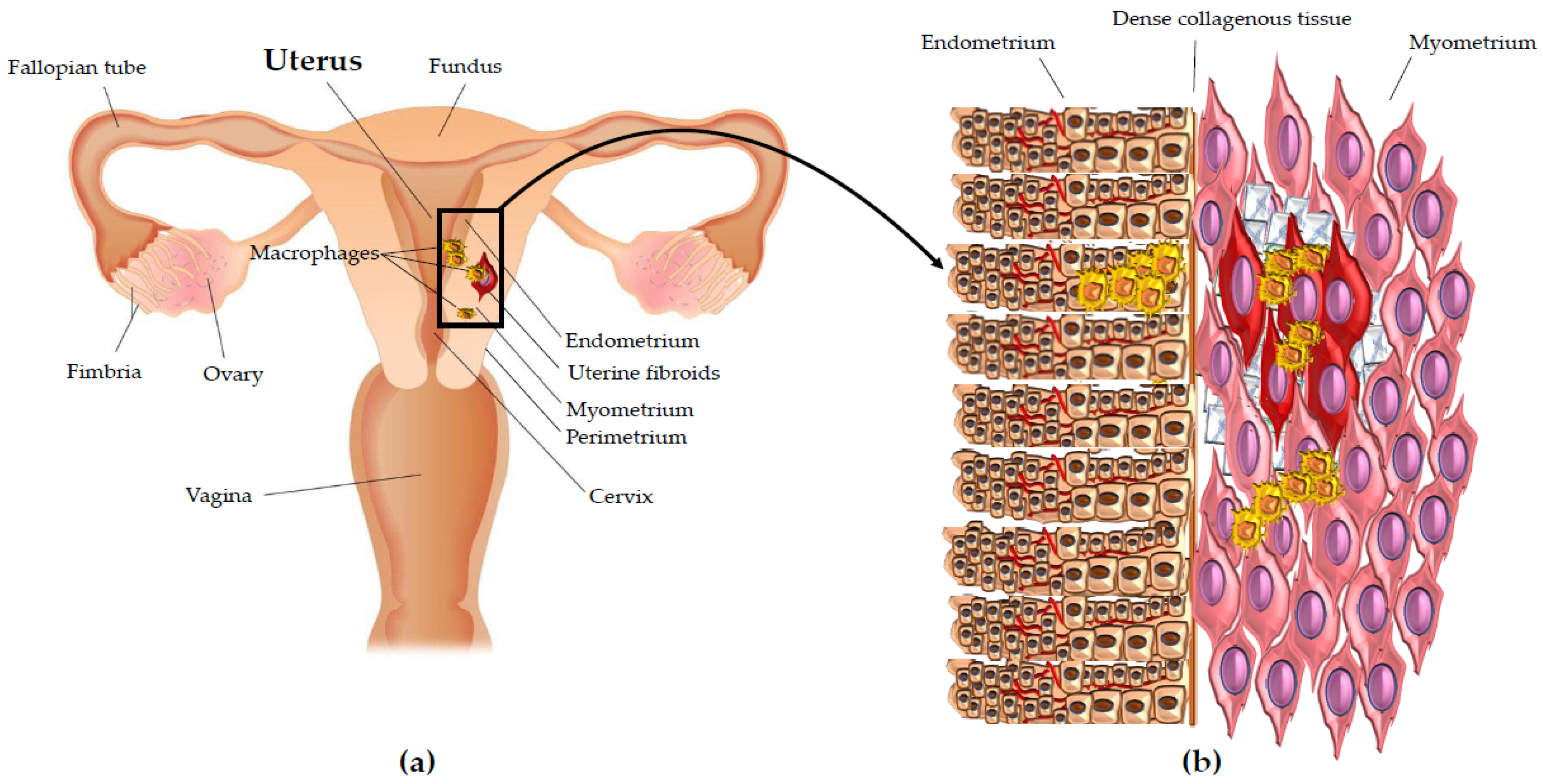 Frontiers  Endometriosis and Uterine Fibroids (Leiomyomata