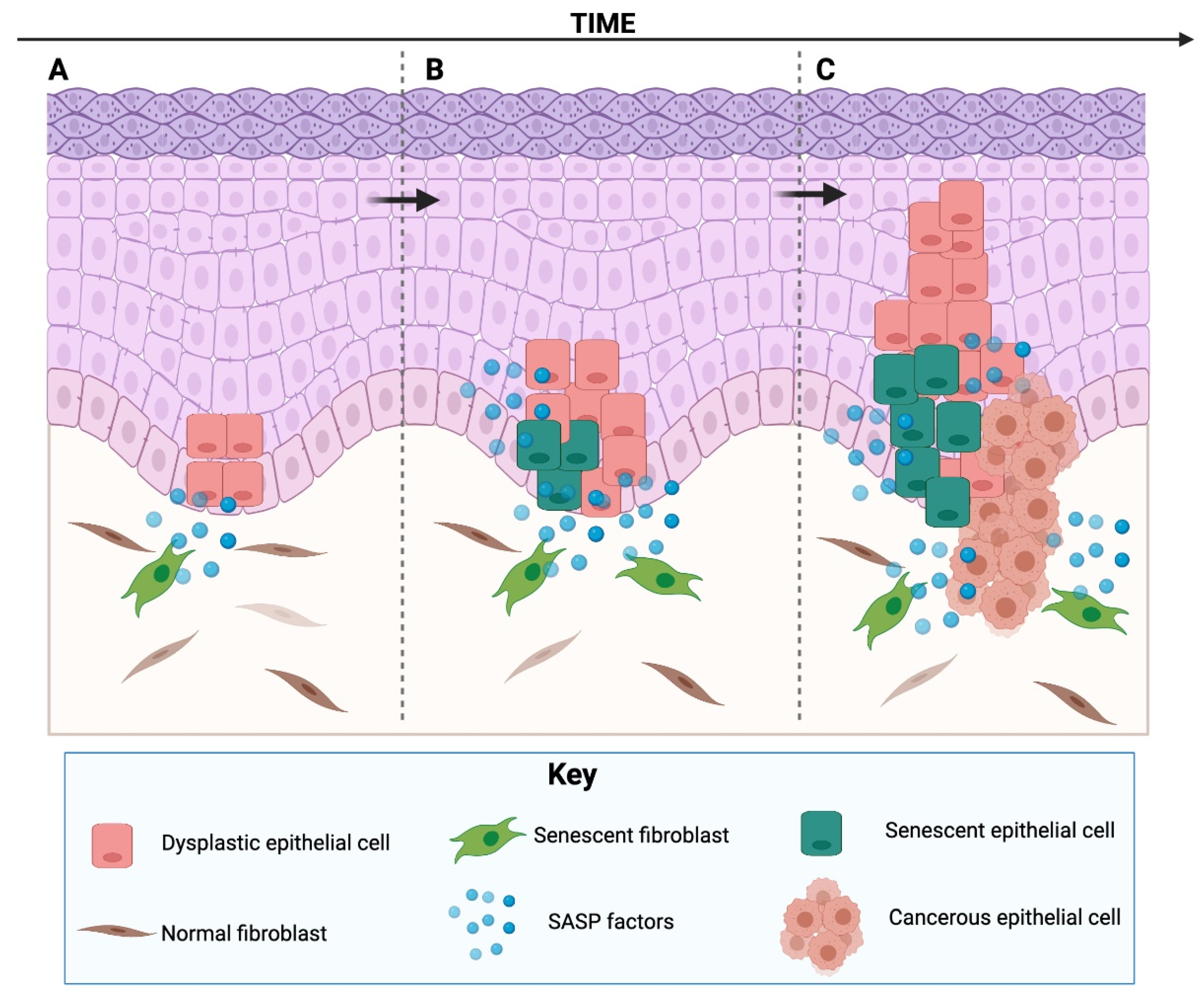 Senescent Cells in Cancer: Wanted or Unwanted Citizens