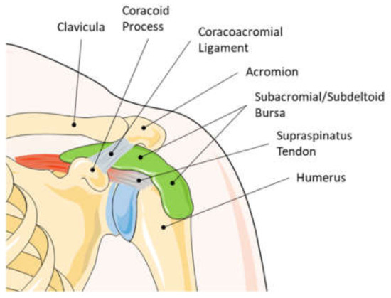 humeroscapularis osteoarthritis)