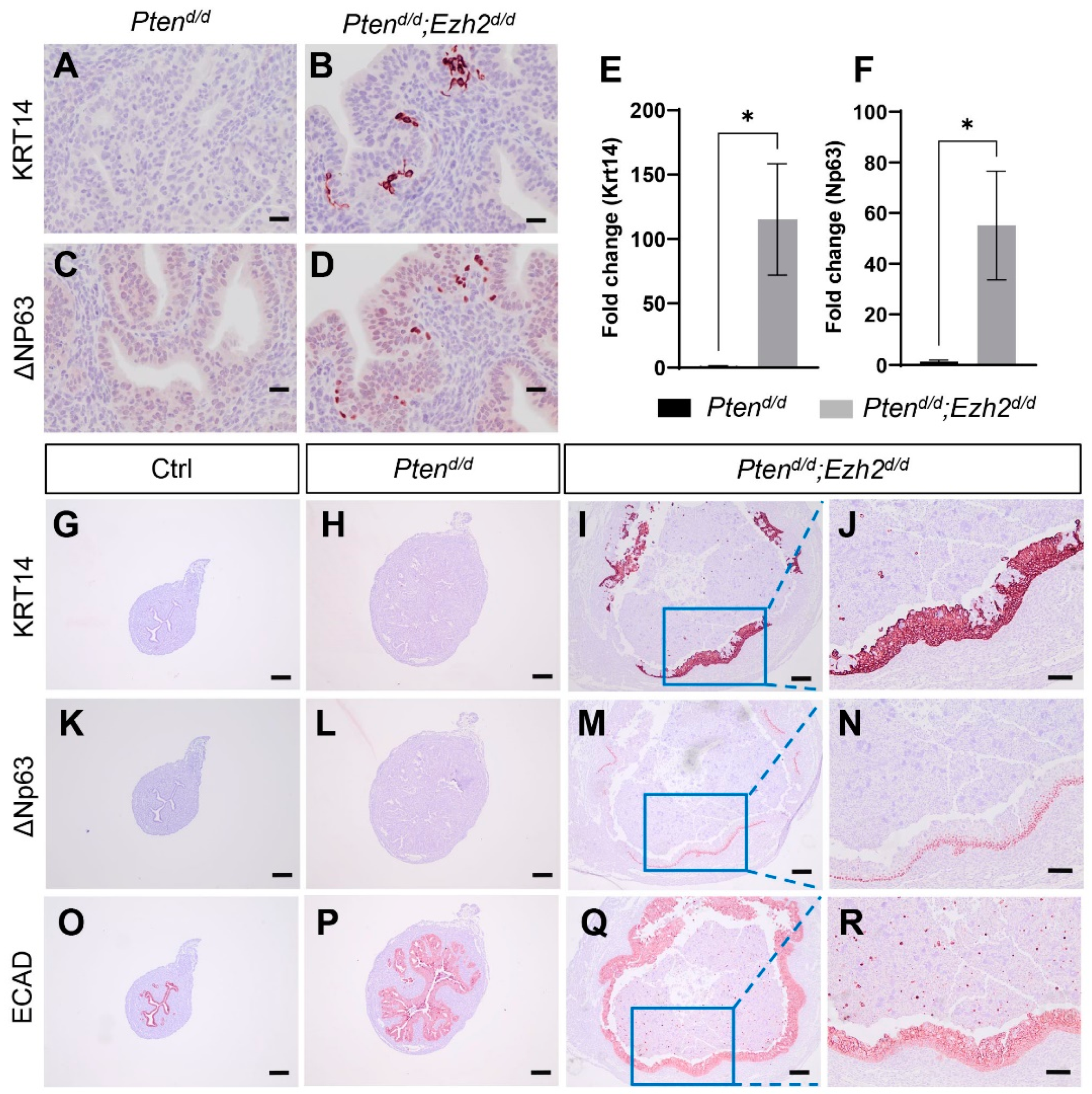 EZH2 and Endometrial Cancer Development: Insights from a EZH2 and Endometrial Cancer Development: Insights from a