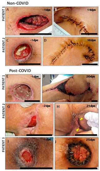Skin & Pressure Sores after Spinal Cord Injury