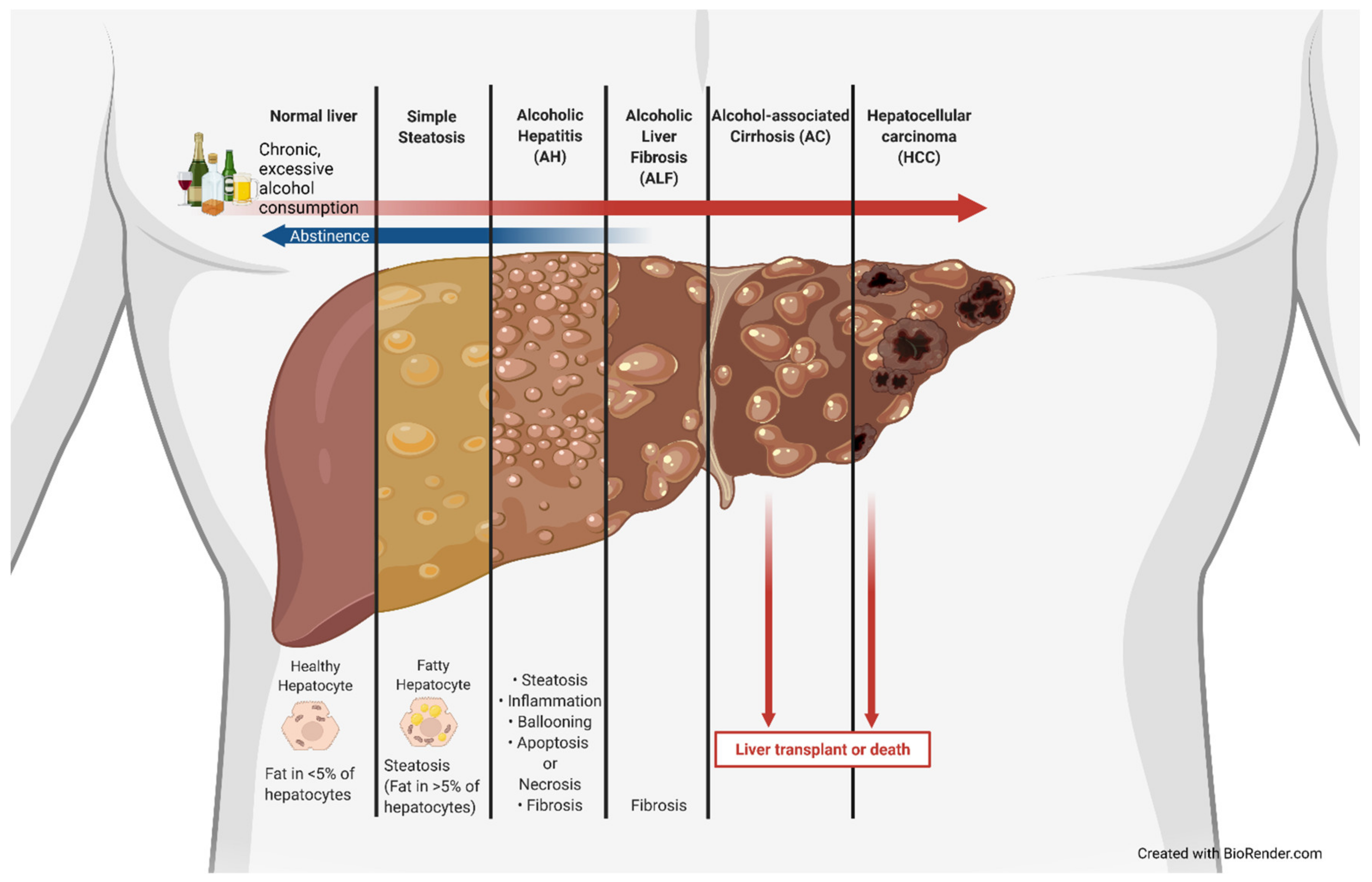 Study Finds Non-Heavy Alcohol Use Associated with Liver Fibrosis