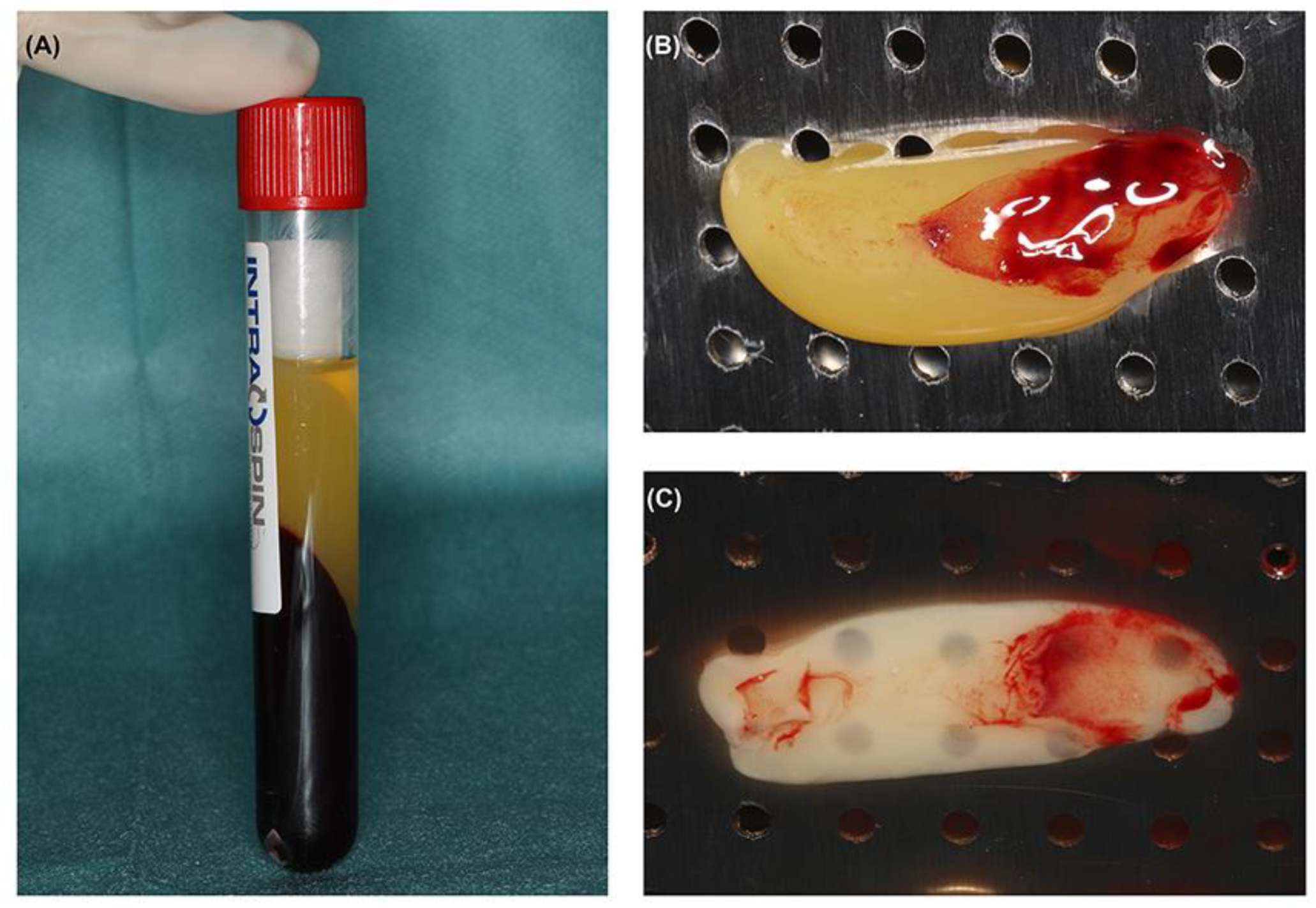 In Vitro and Ex Vivo Kinetic Release Profile of Growth Factors and ...