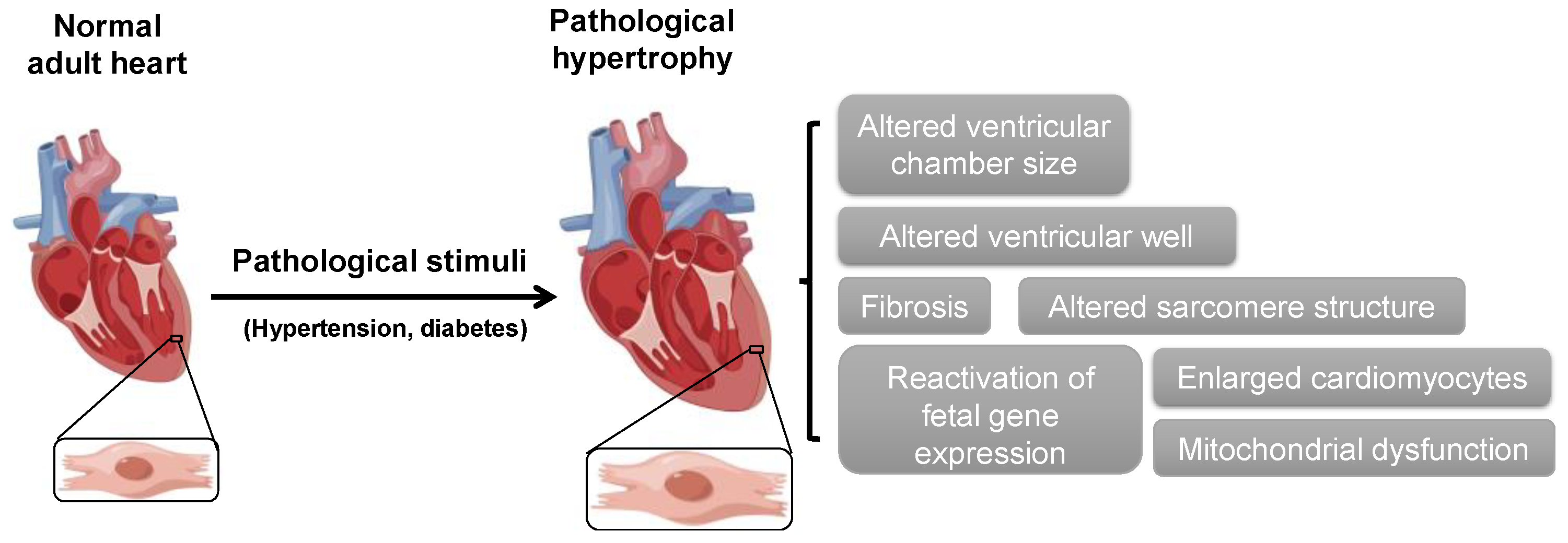 hypertrophy of the heart