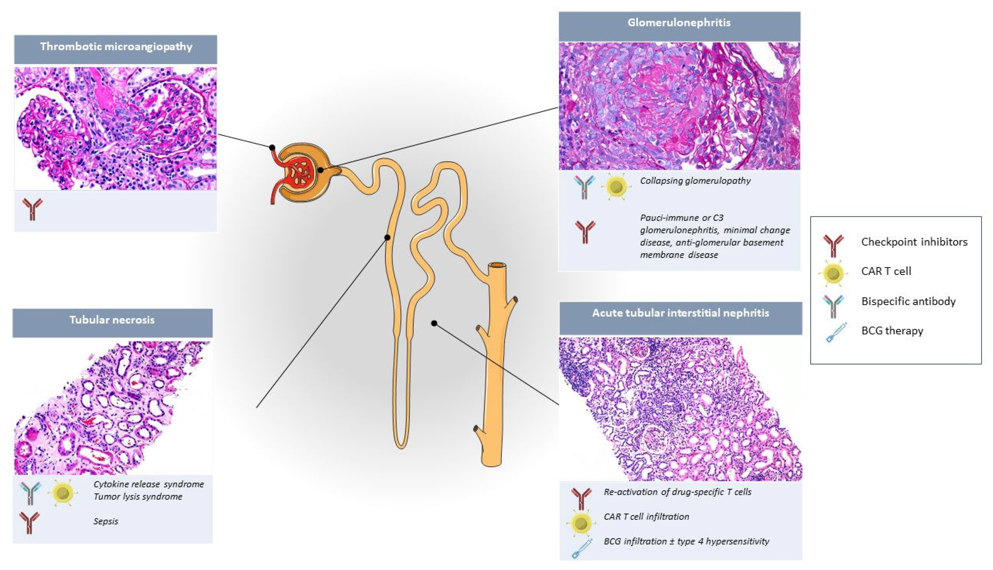 Acute Kidney Injury in Cancer Immunotherapy Recipients