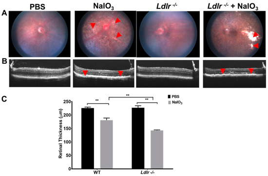 Oxidative Stress and Lipid Accumulation Augments Cell Death