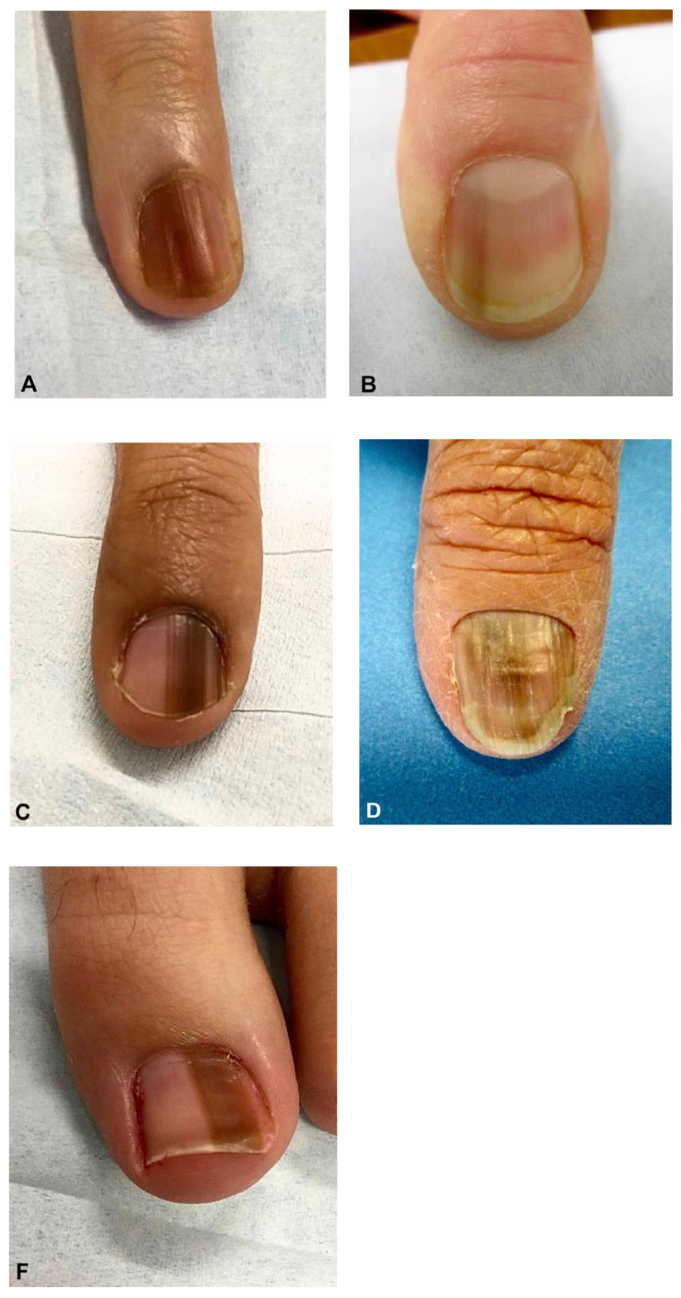 Is the Black Line on Your Nail Normal or Melanoma How To tell