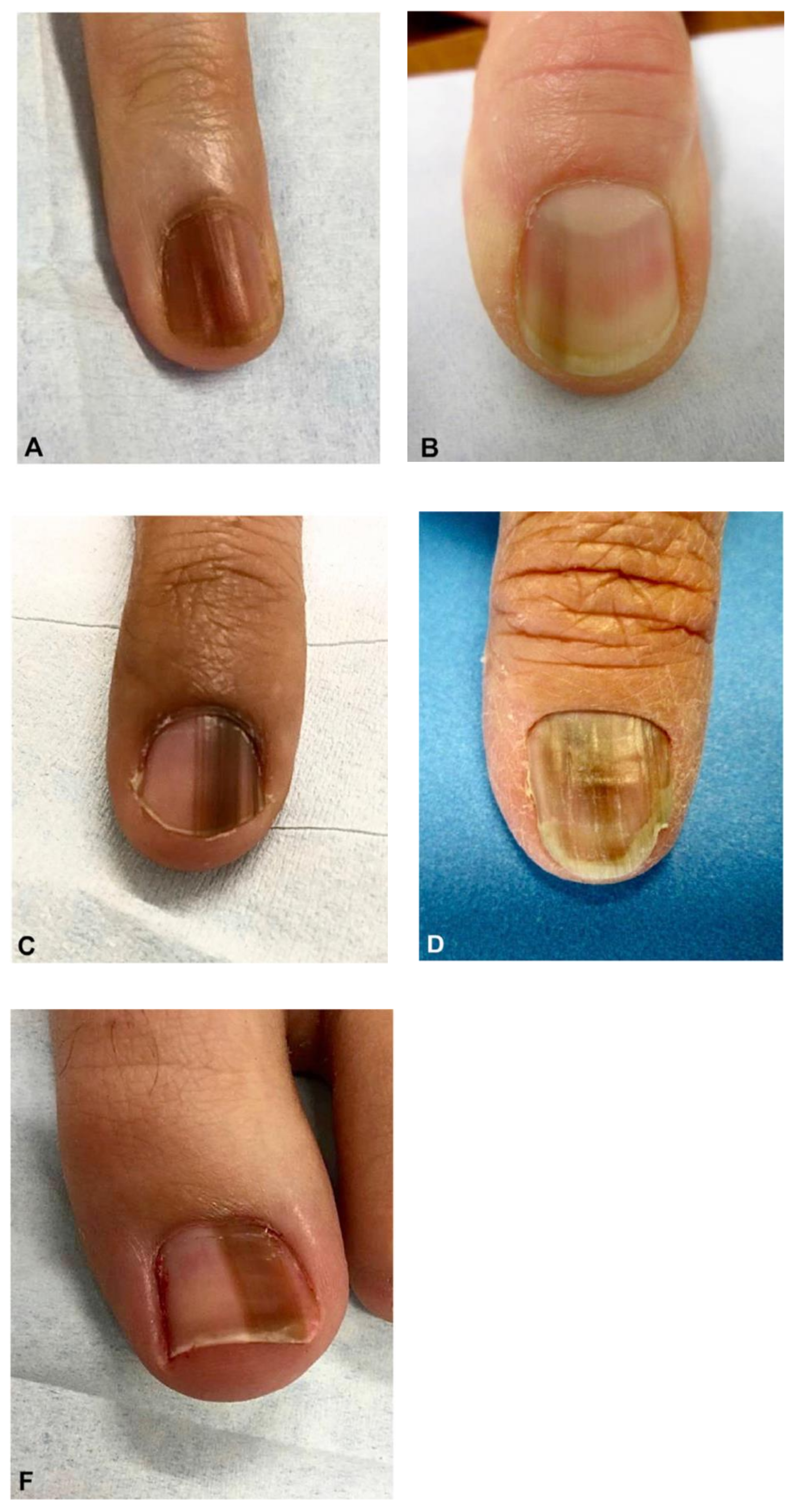 Median nail dystrophy | CMAJ