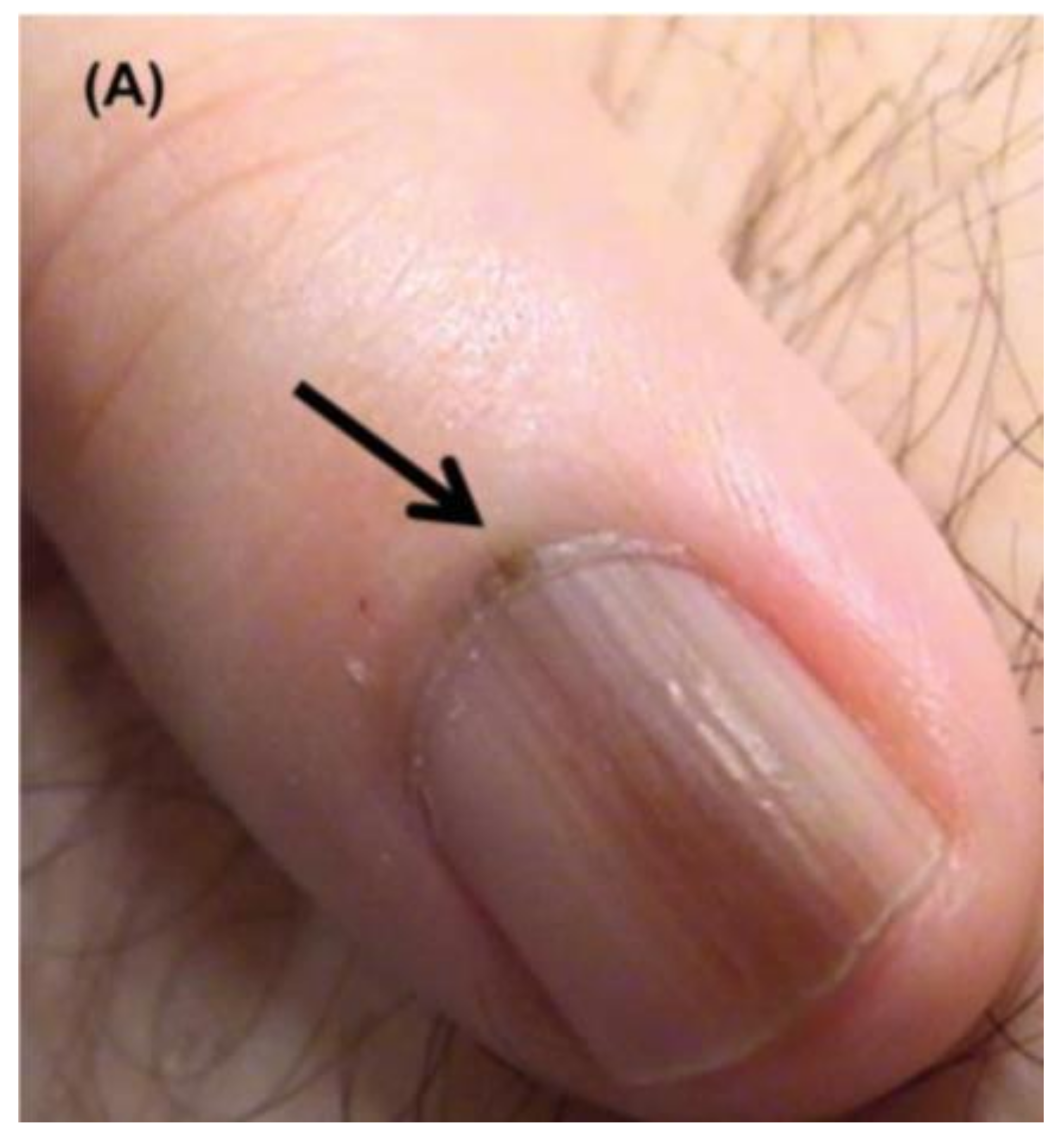 Pigmented lesion on nail bed: Pseudo-Hutchinson sign | Cleveland Clinic  Journal of Medicine