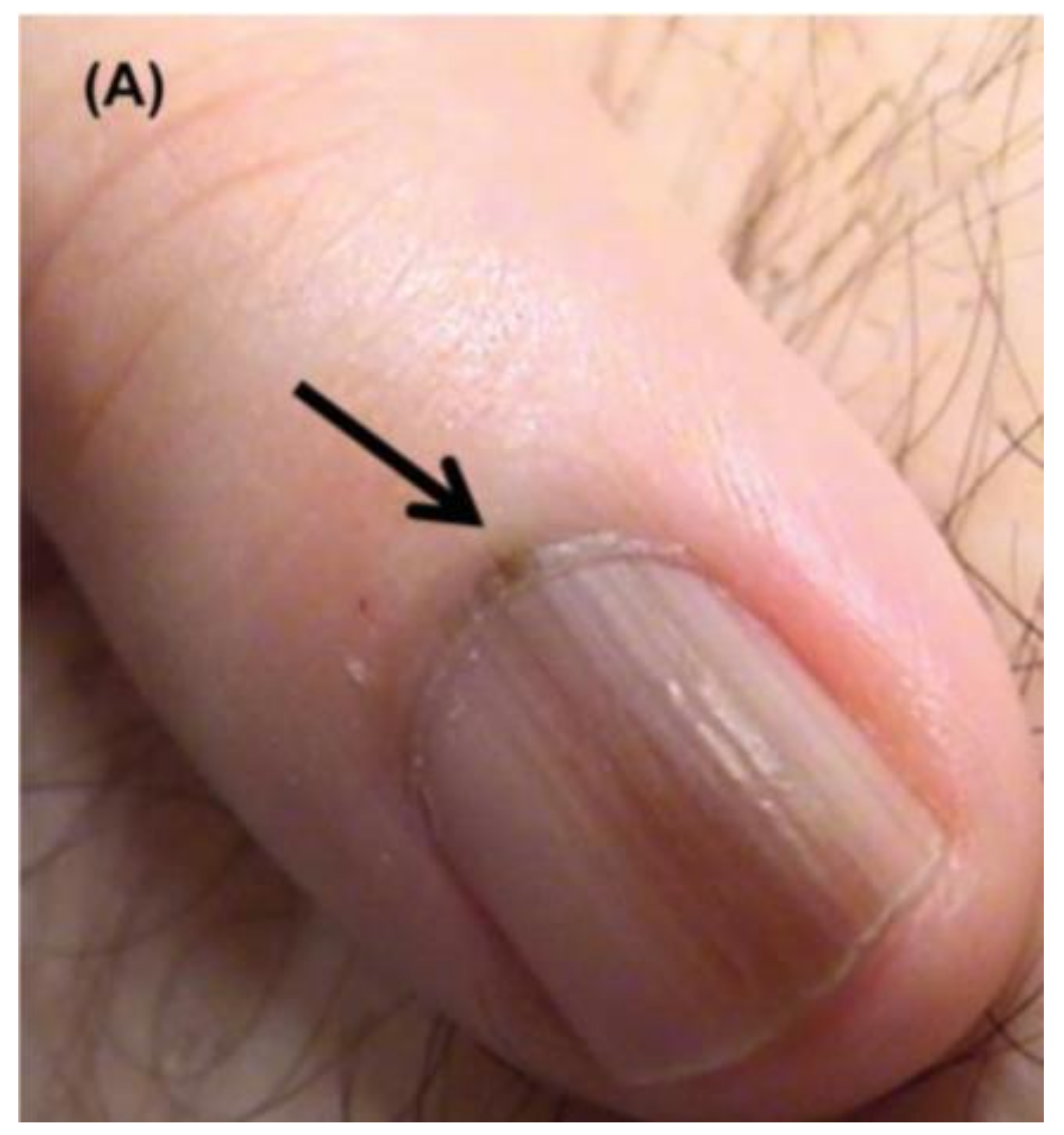 Hutchinson Sign Nail Melanoma My Bios