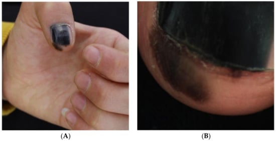 Distinct Nail Pigmentation as Sign of Early Melanoma (10.05.2019)