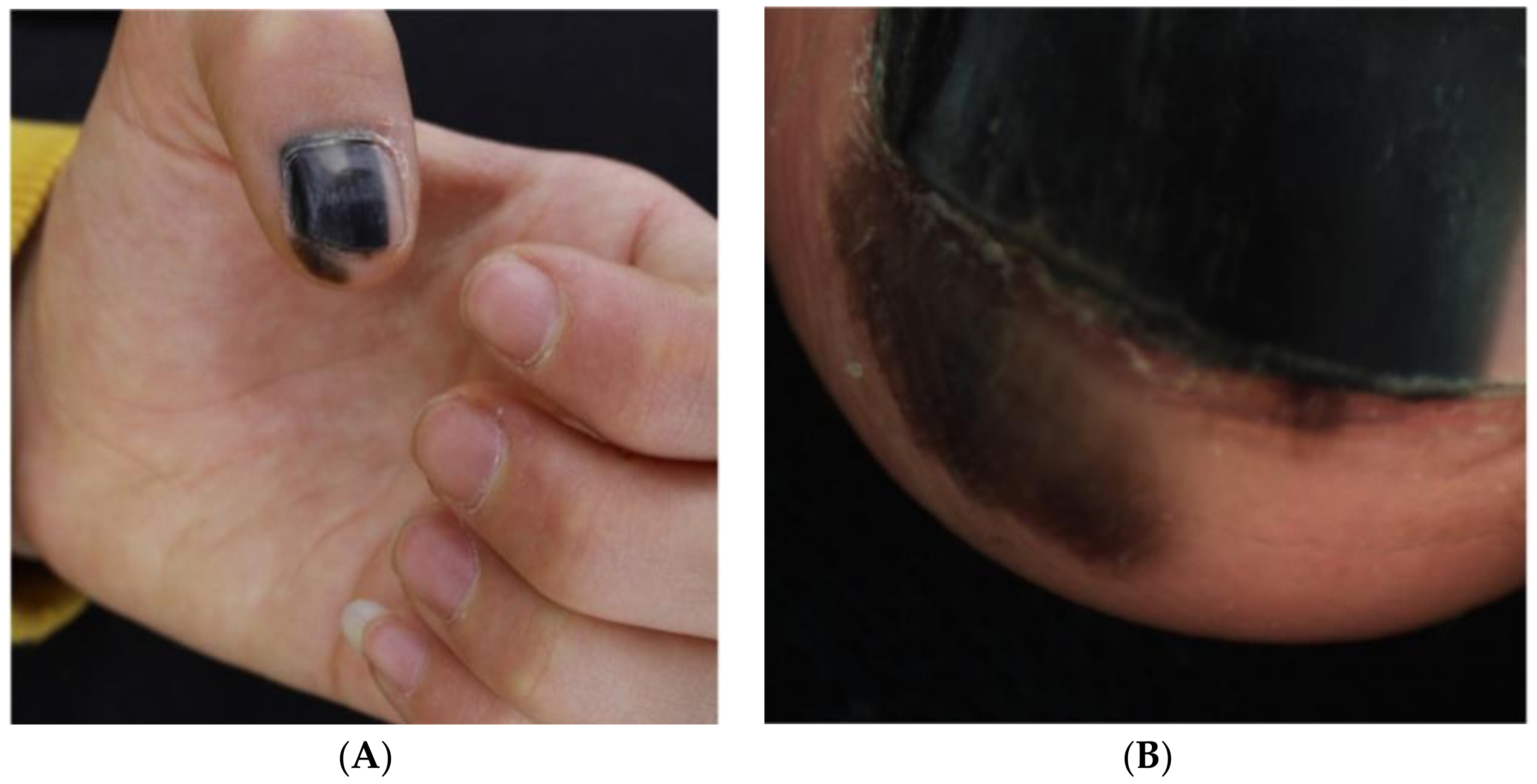 RACGP - Pigmented lesions of the nail bed – Clinical assessment