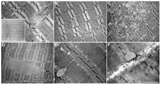 Characterization of Skeletal Muscle Biopsy and Derived Myoblasts in a ...