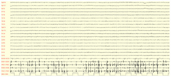 Familial Adult Myoclonus Epilepsy: A Non-Coding Repeat Expansion ...