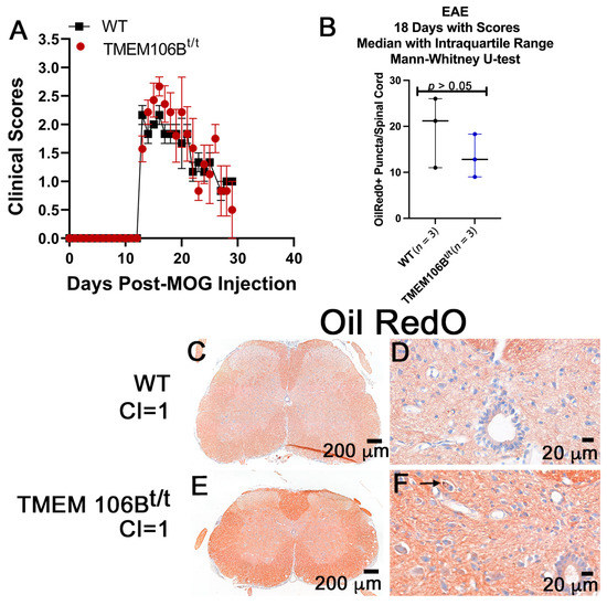 TMEM106B Puncta Is Increased in Multiple Sclerosis Plaques, and