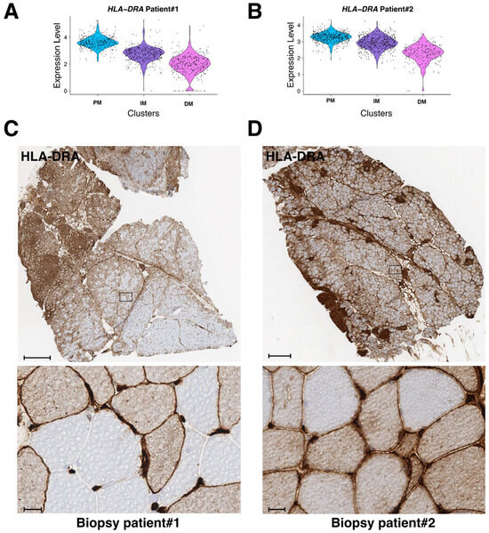 Spatial Transcriptomics Reveals Signatures of Histopathological Changes ...