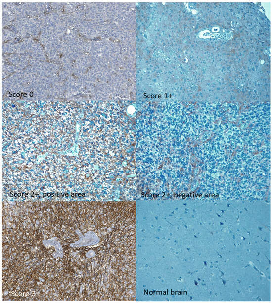 CD99 Expression and Prognostic Impact in Glioblastoma: A Single-Center ...