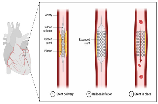 健康・医学 HEART DISEASE Hypertrophic Cardiomyopathy Patient Tools - PCNA
