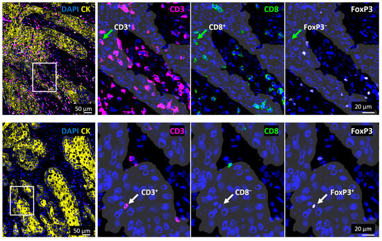 Spatial Distribution and Prognostic Value of T Cell Subtypes