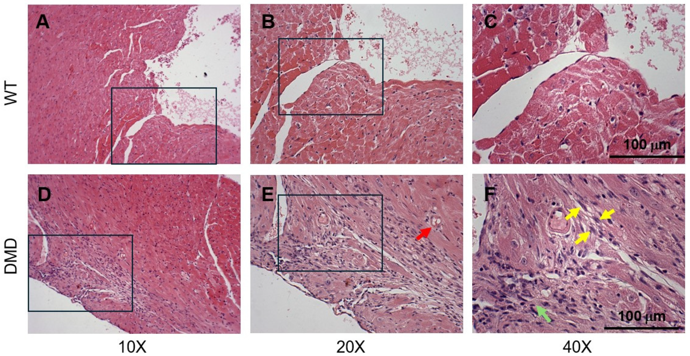 器官病理学 = Organ Pathology 15.Female genital organs (10) Granular cell tumor|Pathology