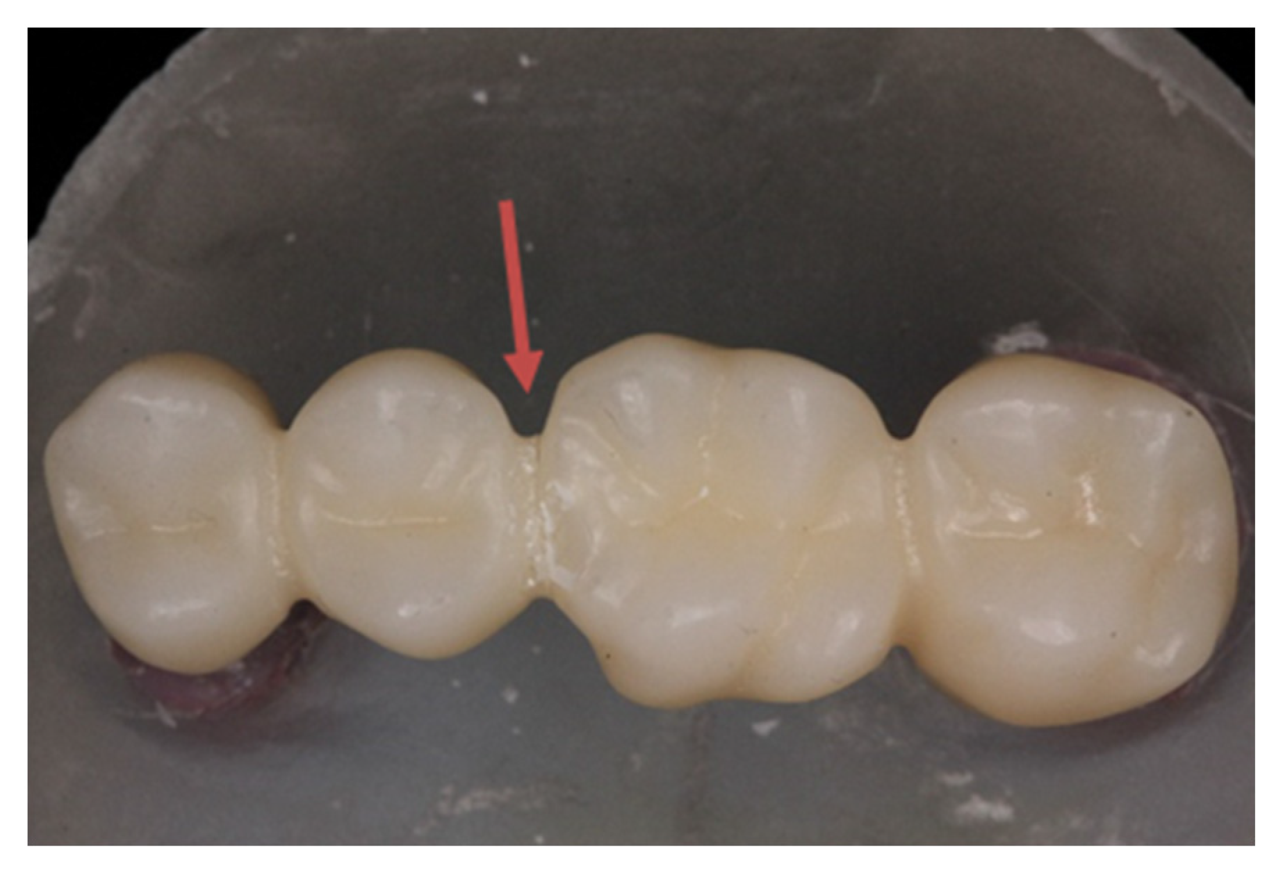 Army Butcher Voyage Ceramics | Free Full-Text | 4-Unit Molar Fixed Partial Dentures Made from  Highly Translucent and Multilayer Zirconia Materials: An In Vitro  Investigation