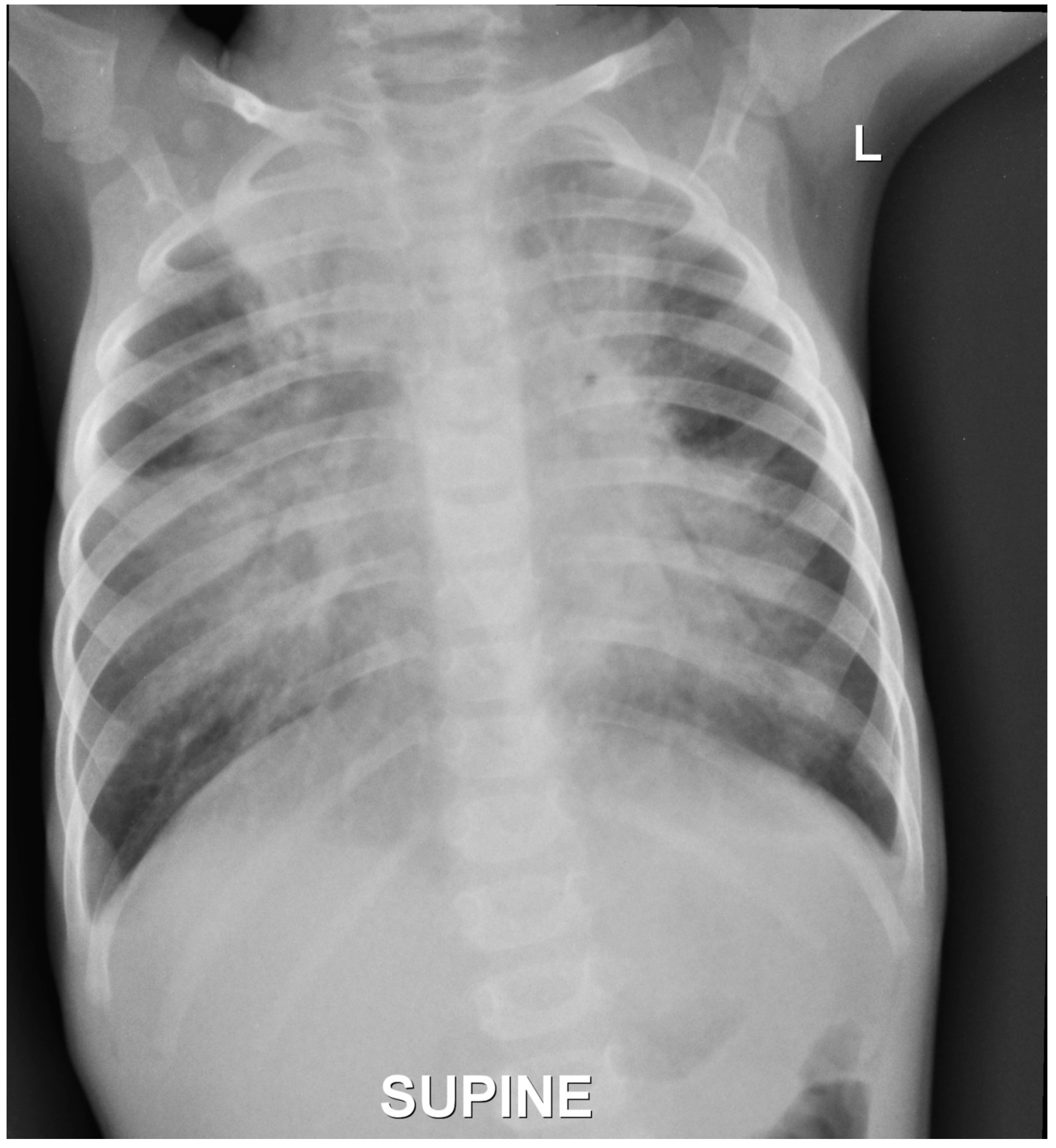 PDF) Barium esophagogram in various esophageal diseases: A pictorial essay