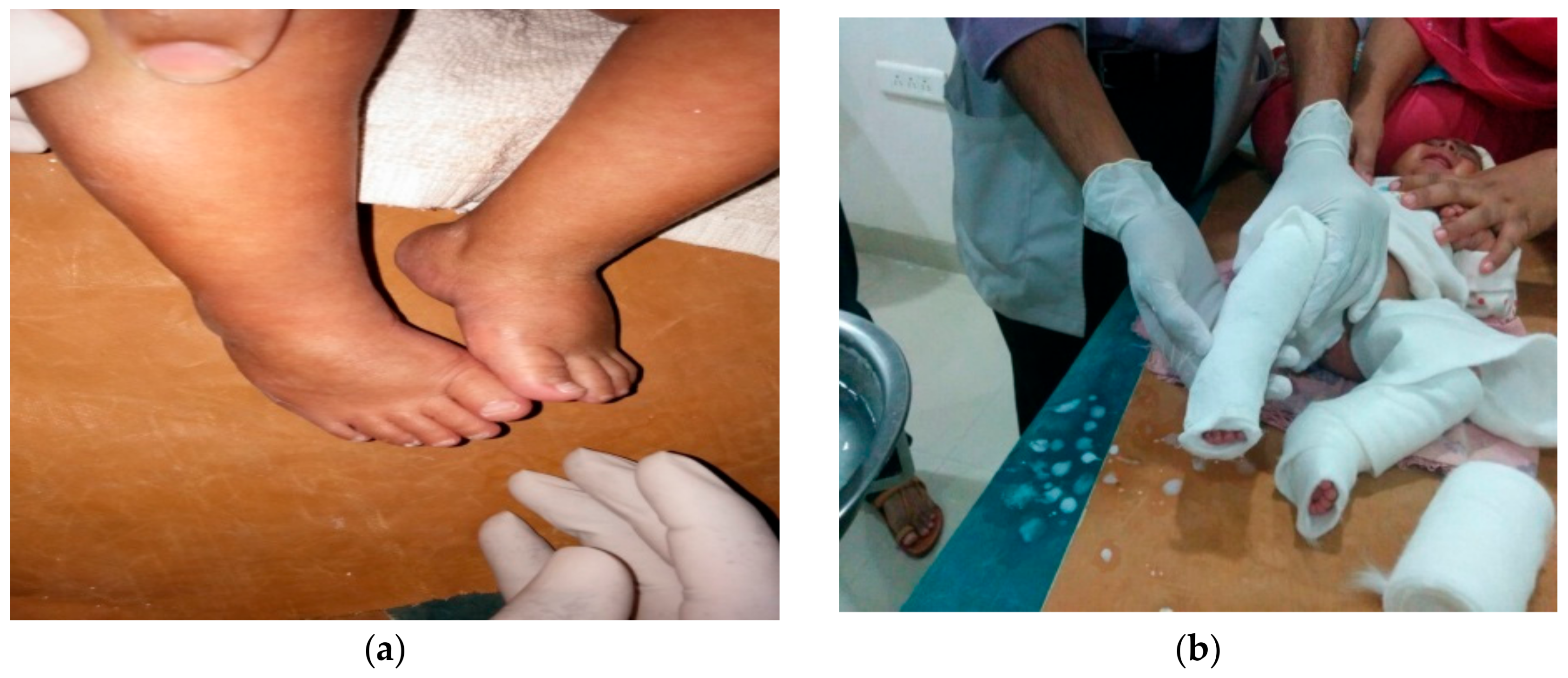 Children Free FullText Ponseti Technique for the Management of