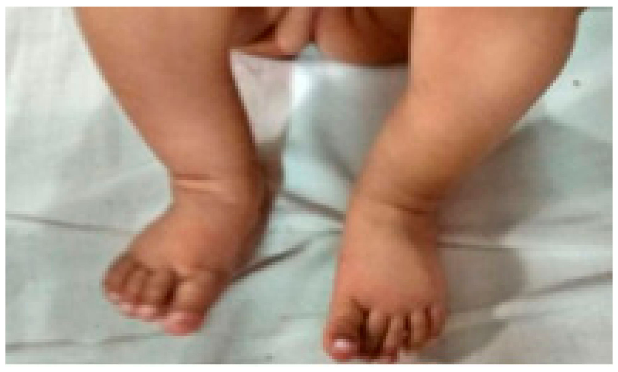 Children Free Full Text Ponseti Technique For The Management Of Congenital Talipes Equinovarus In A Rural Set Up In India Experience Of 356 Patients Html