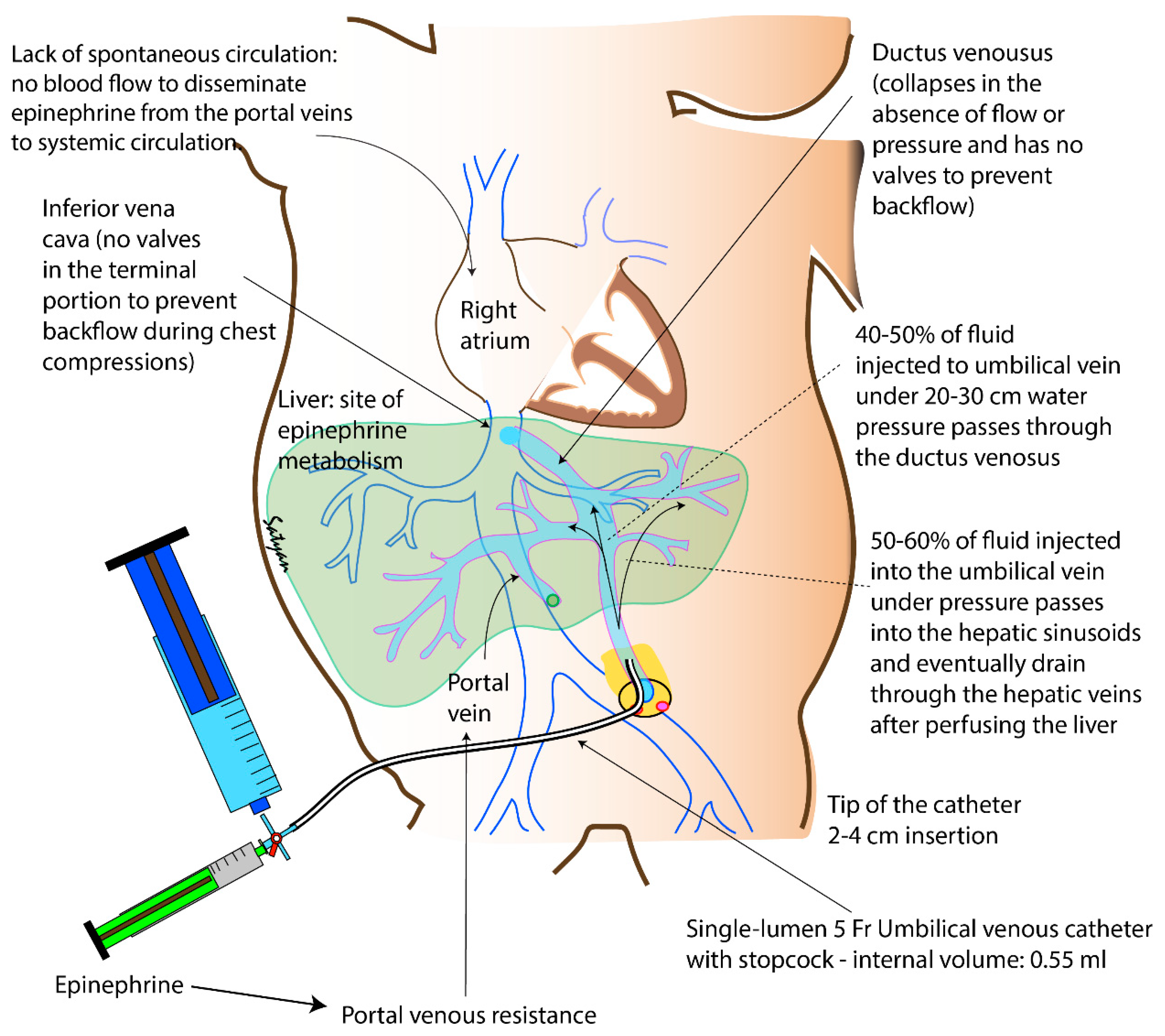 Children Free Full Text Epinephrine In Neonatal Resuscitation